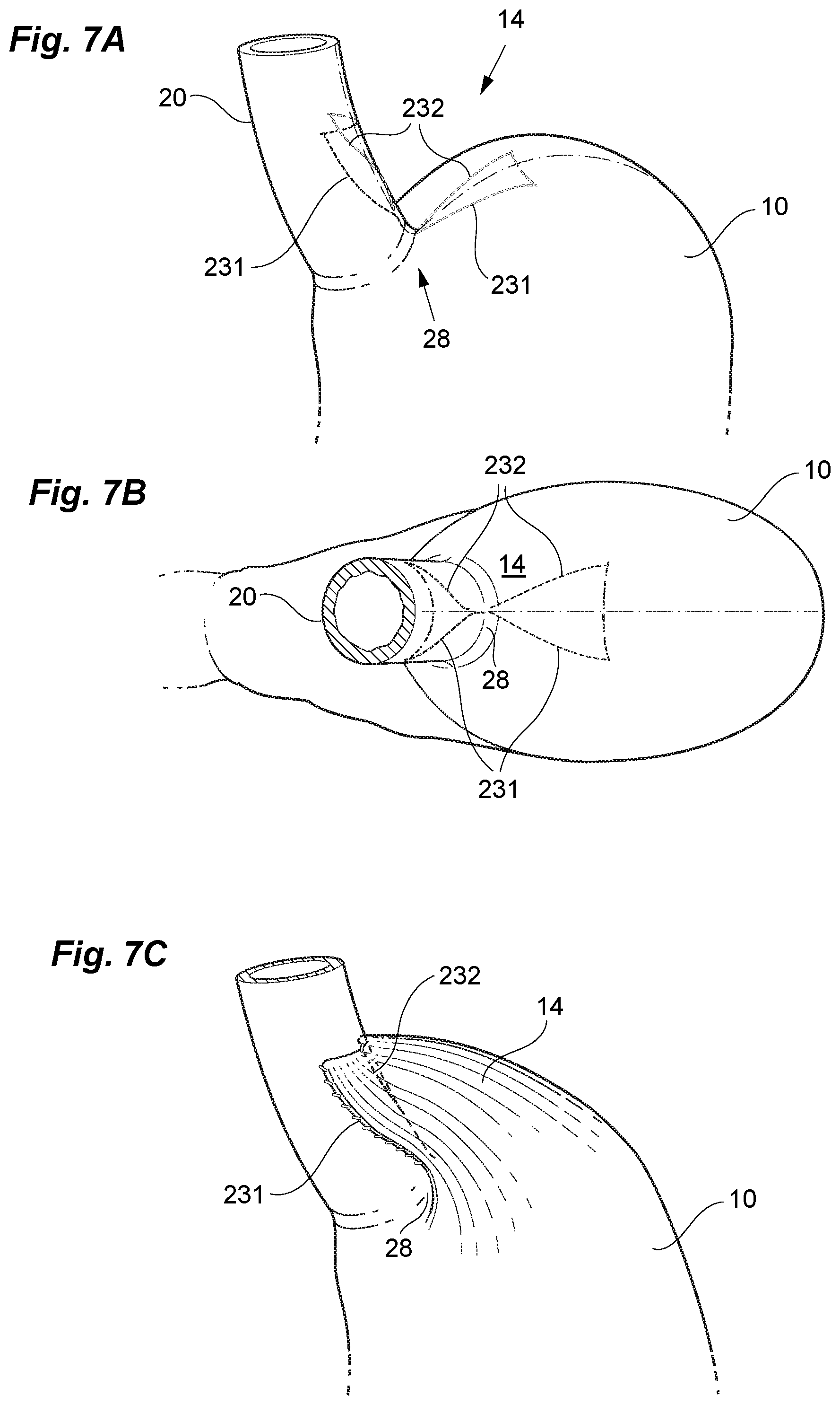 Patent US12097138 Figure 6 – Treatment of GERD