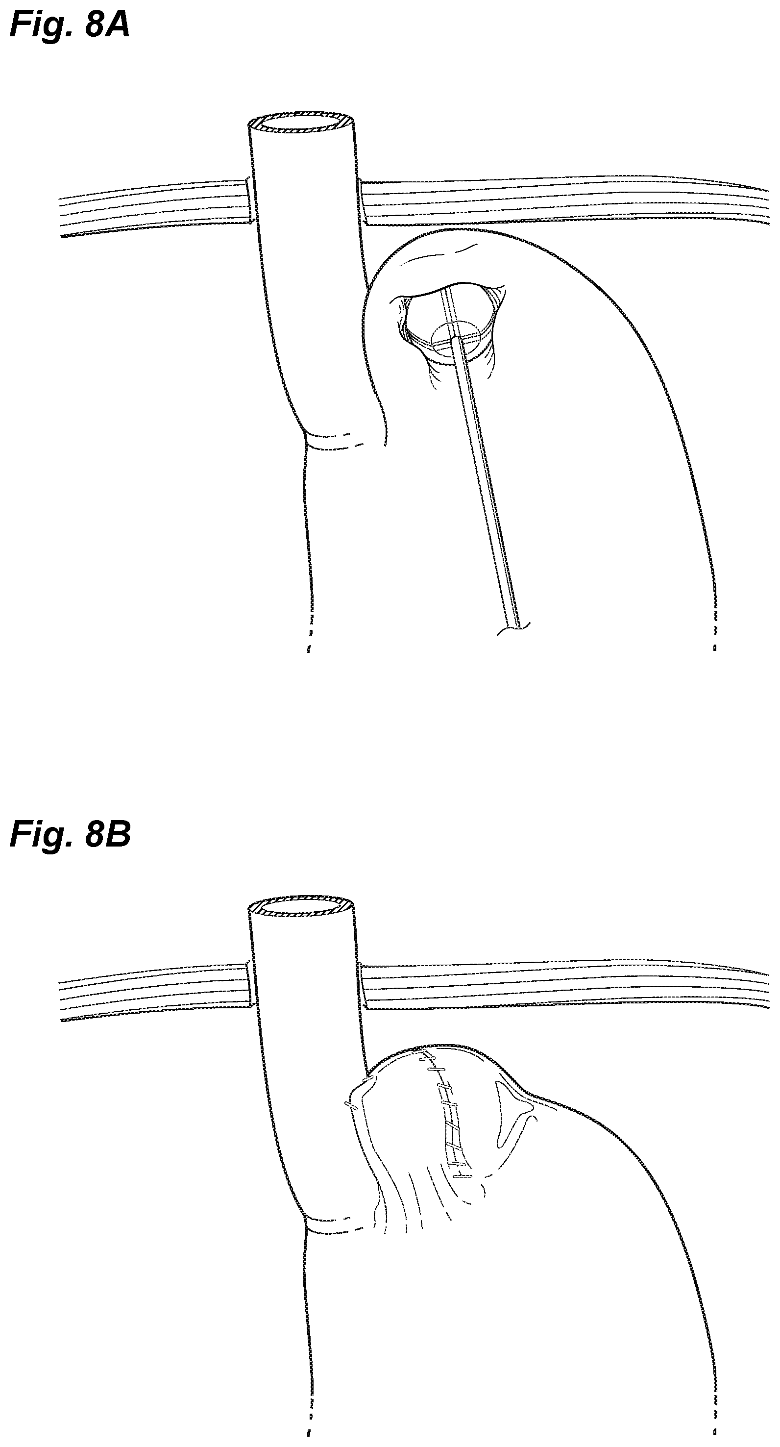 Patent US12097138 Figure 7 – Treatment of GERD