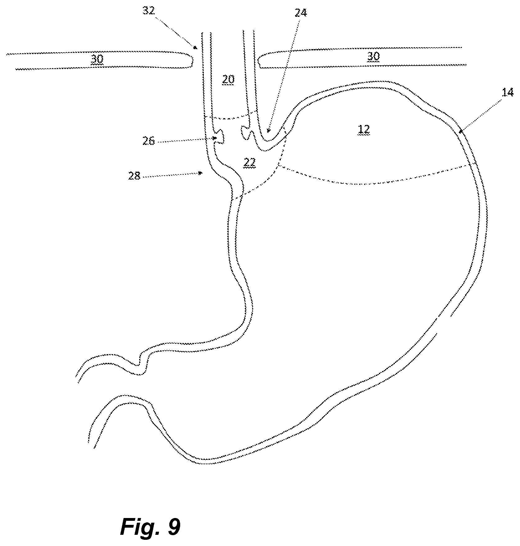 Patent US12097138 Figure 8 – Treatment of GERD