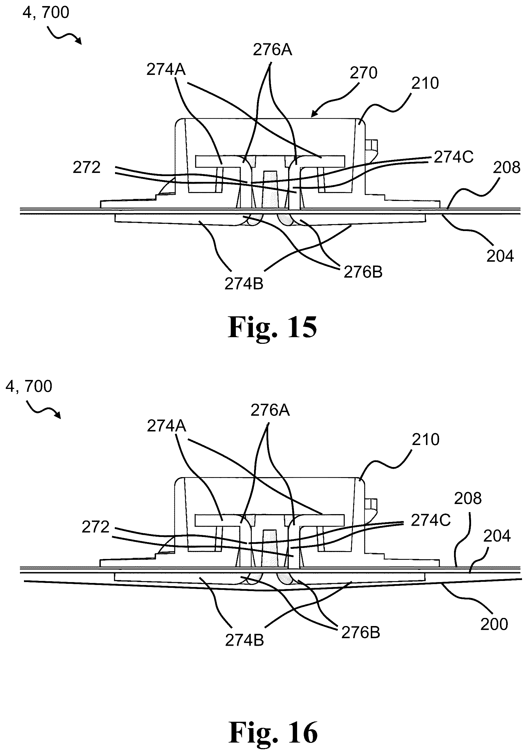 Patent US12097141 Figure 14 – Medical system having a monitor attachable to an ostomy appliance and to a docking station