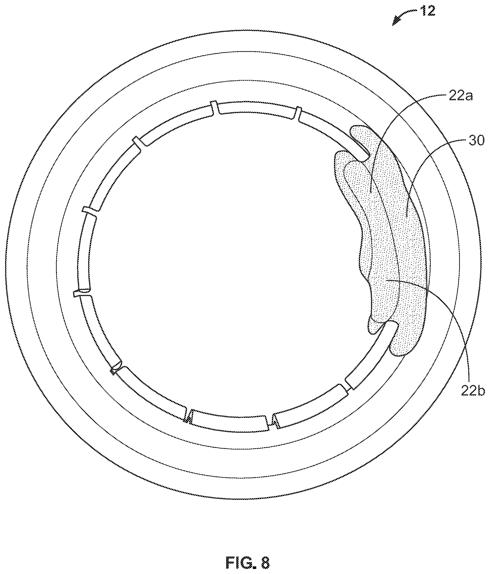 Patent US12097142 Figure 5 – Ostomy appliance with customizable barrier ring for localized convex support