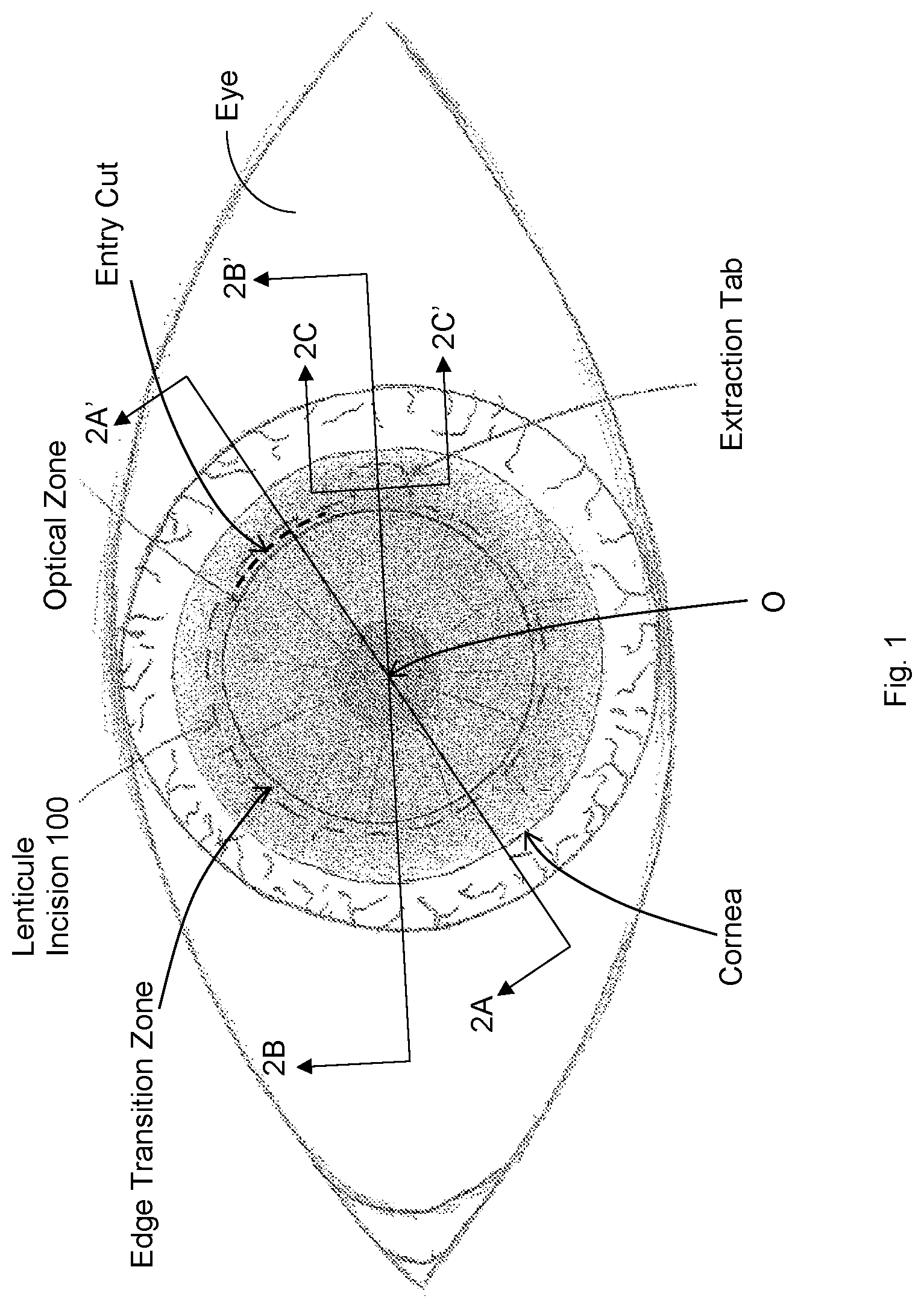 Patent US12097148 Figure 1 – Ophthalmic laser surgical method and system for forming corneal lenticule with side tab for easy extraction