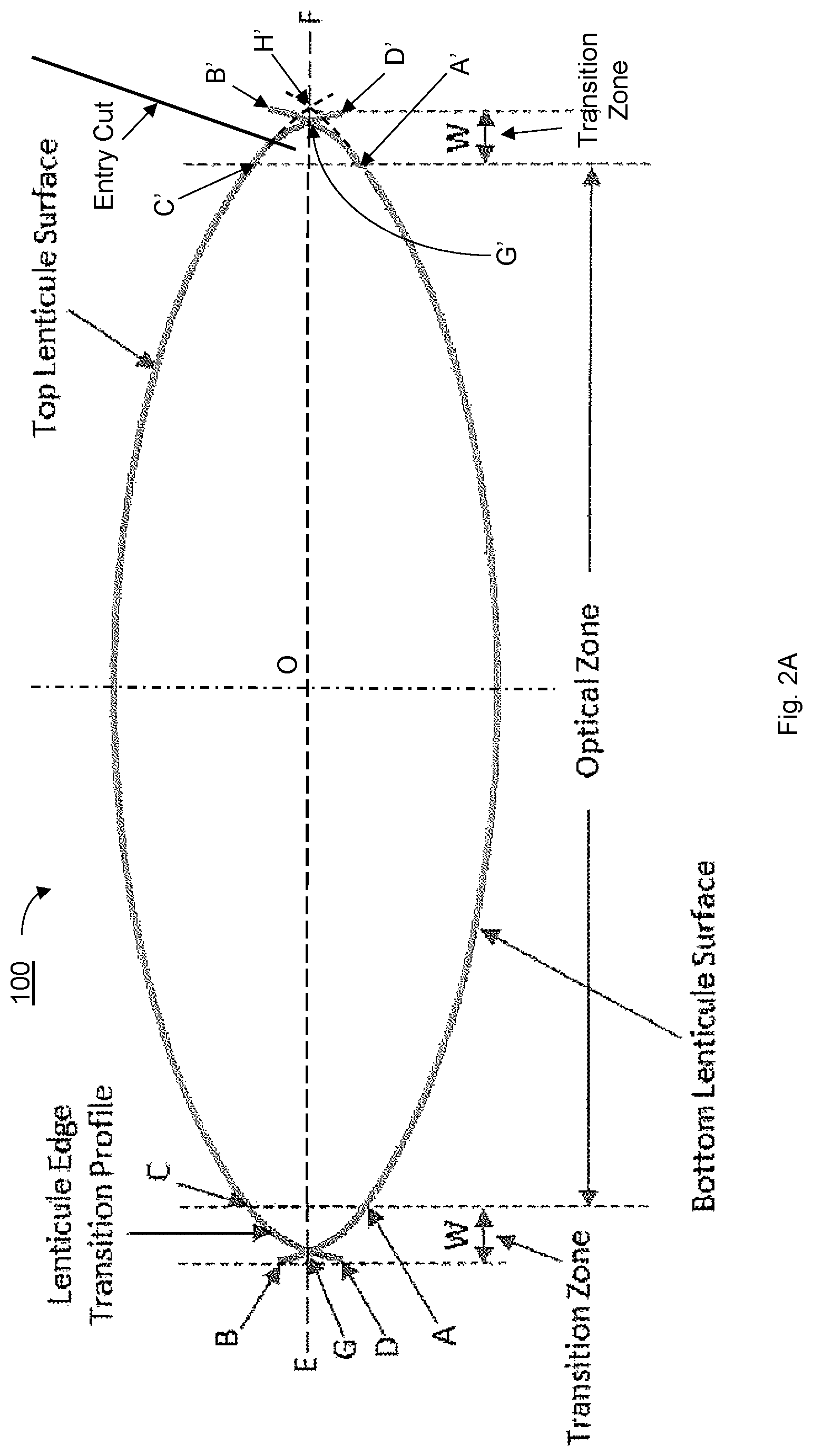 Patent US12097148 Figure 2 – Ophthalmic laser surgical method and system for forming corneal lenticule with side tab for easy extraction