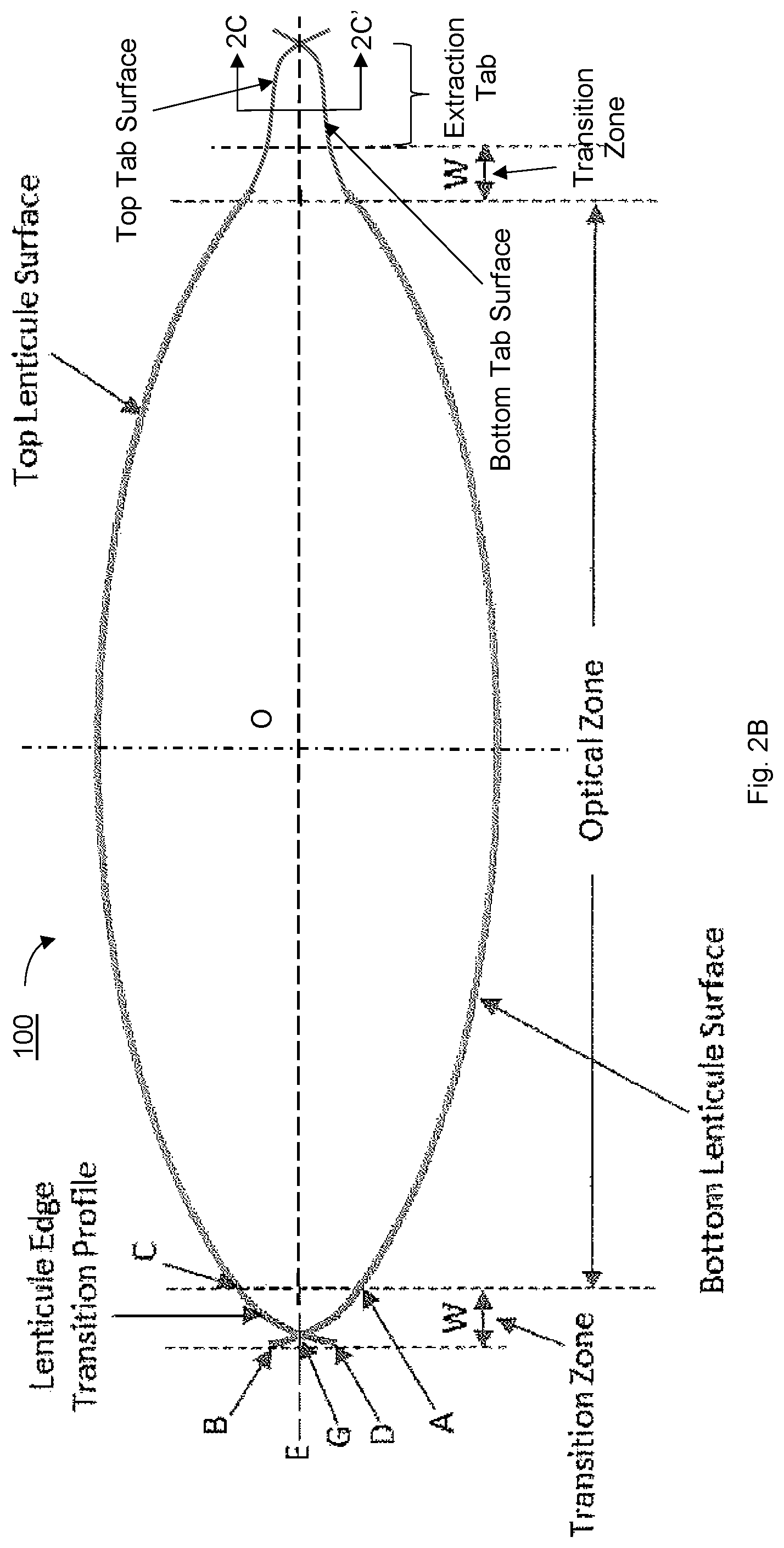 Patent US12097148 Figure 3 – Ophthalmic laser surgical method and system for forming corneal lenticule with side tab for easy extraction