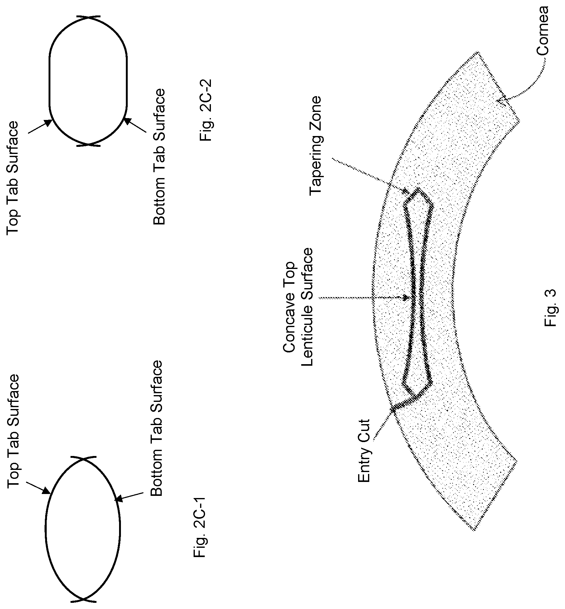 Patent US12097148 Figure 4 – Ophthalmic laser surgical method and system for forming corneal lenticule with side tab for easy extraction