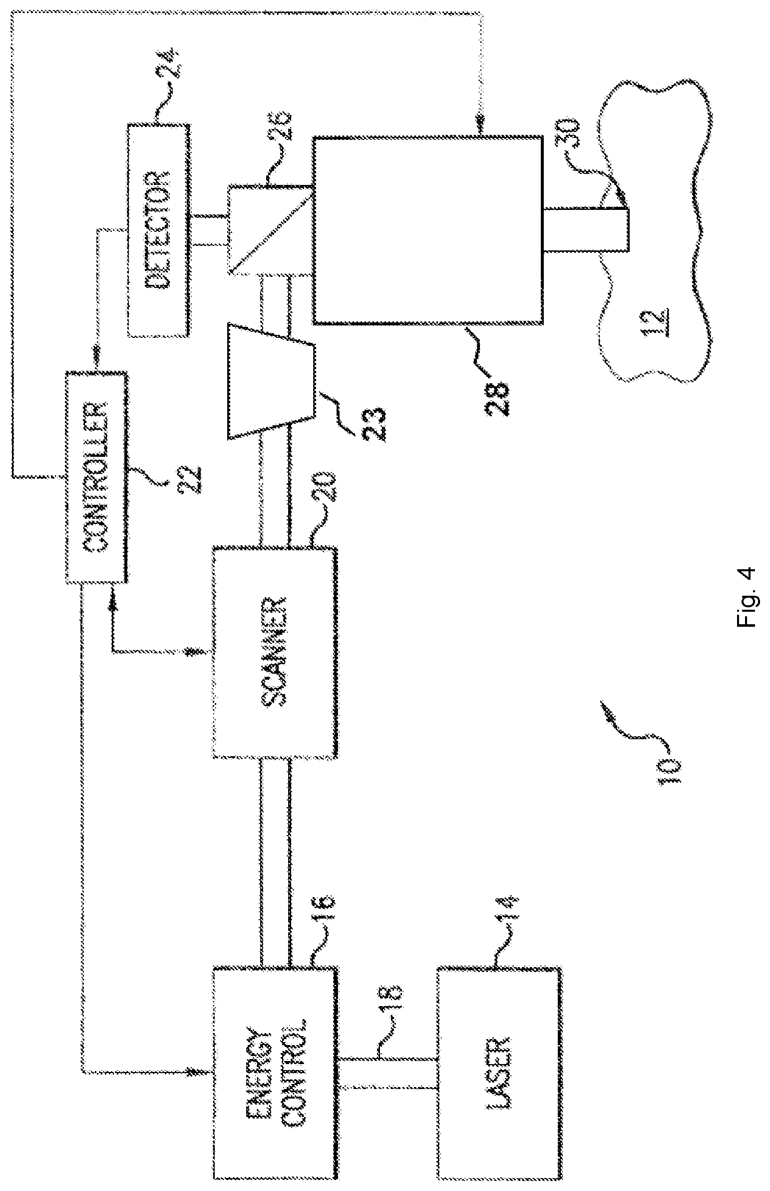 Patent US12097148 Figure 5 – Ophthalmic laser surgical method and system for forming corneal lenticule with side tab for easy extraction