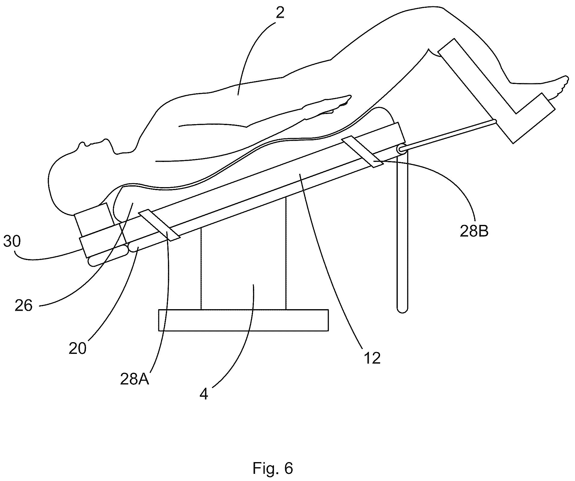 Patent US12097152 Figure 6 – Patient securement system for the surgical Trendelenburg position