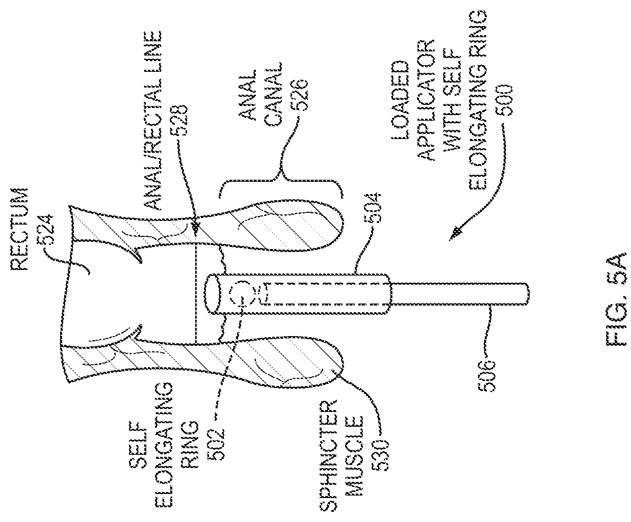 Patent US12097288 Figure 6 – Hydrocortisone acetate suppository formulation for treatment of disease