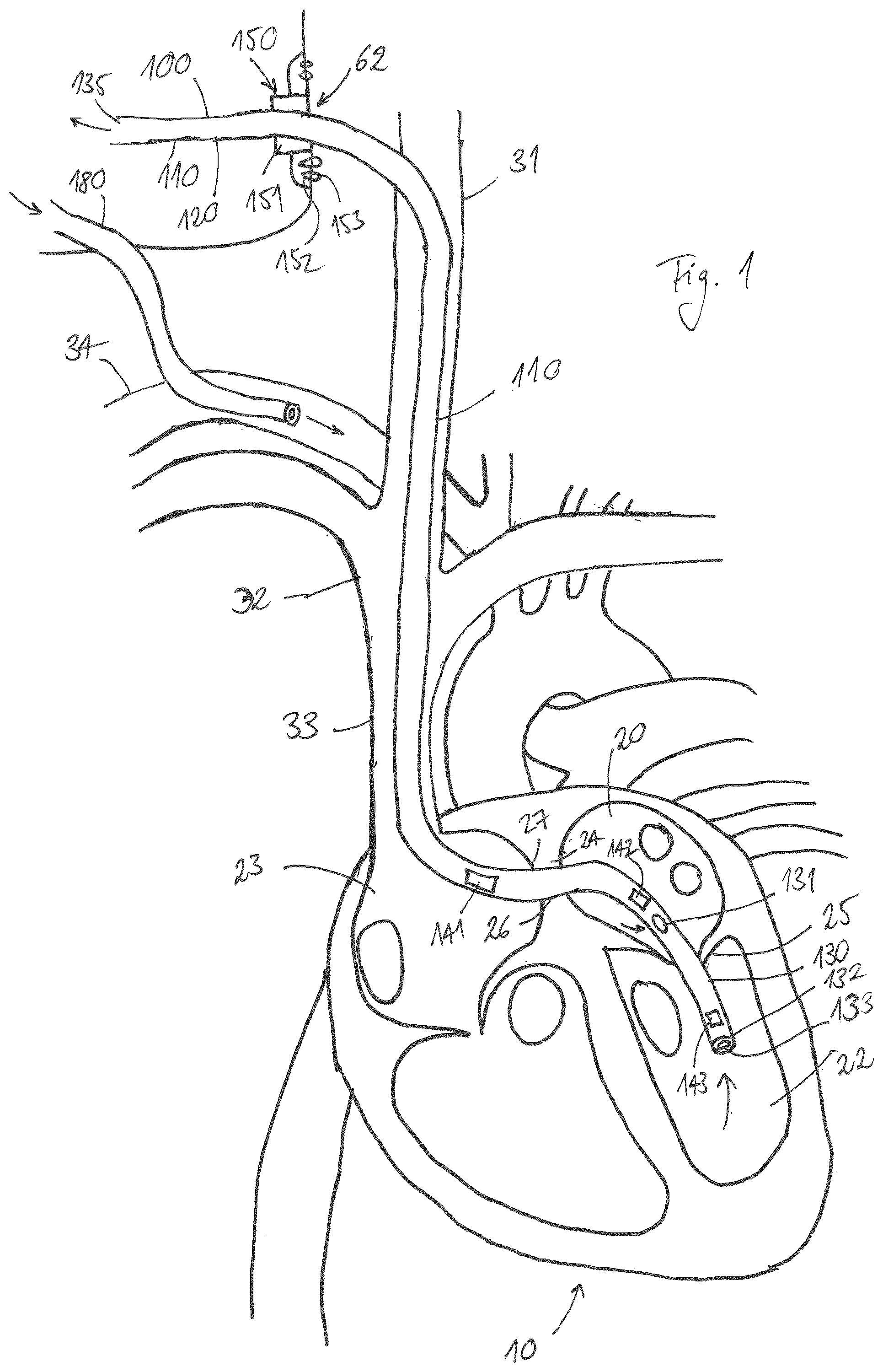 Patent US12097315 Figure 1 – Cardiac drainage cannula and related methods and systems