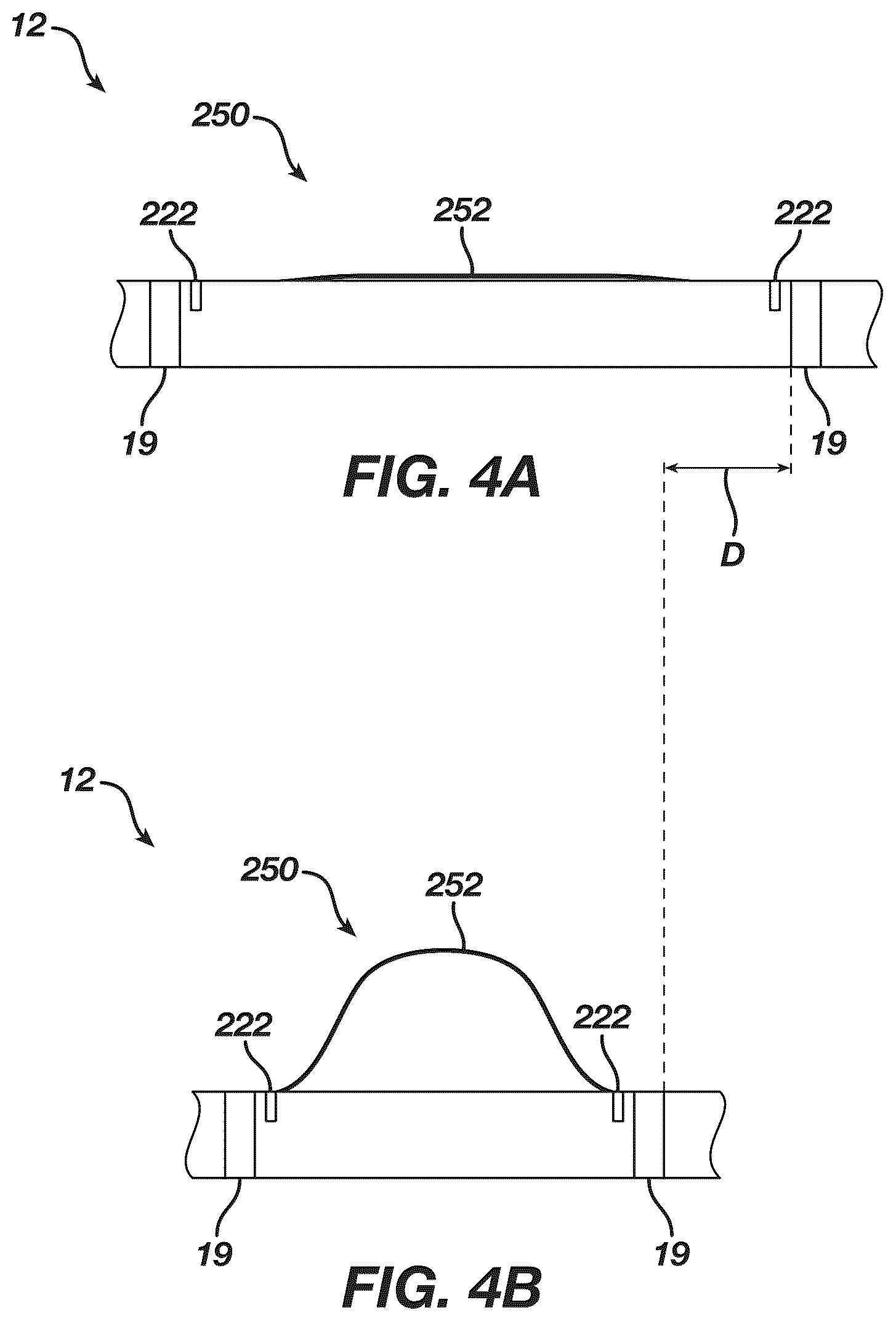 Patent US12097339 Figure 4 – System and methods of using a catheter with an anchoring mechanism