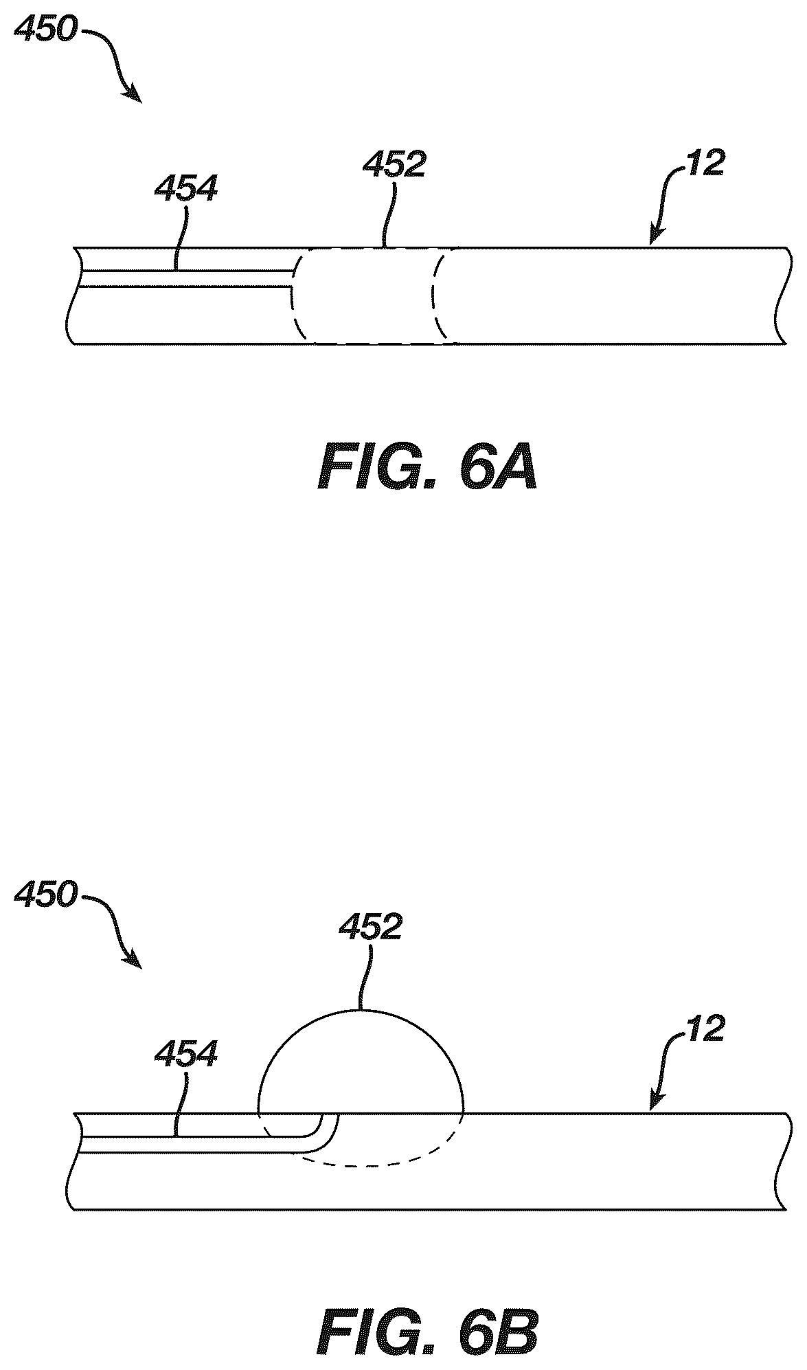 Patent US12097339 Figure 6 – System and methods of using a catheter with an anchoring mechanism