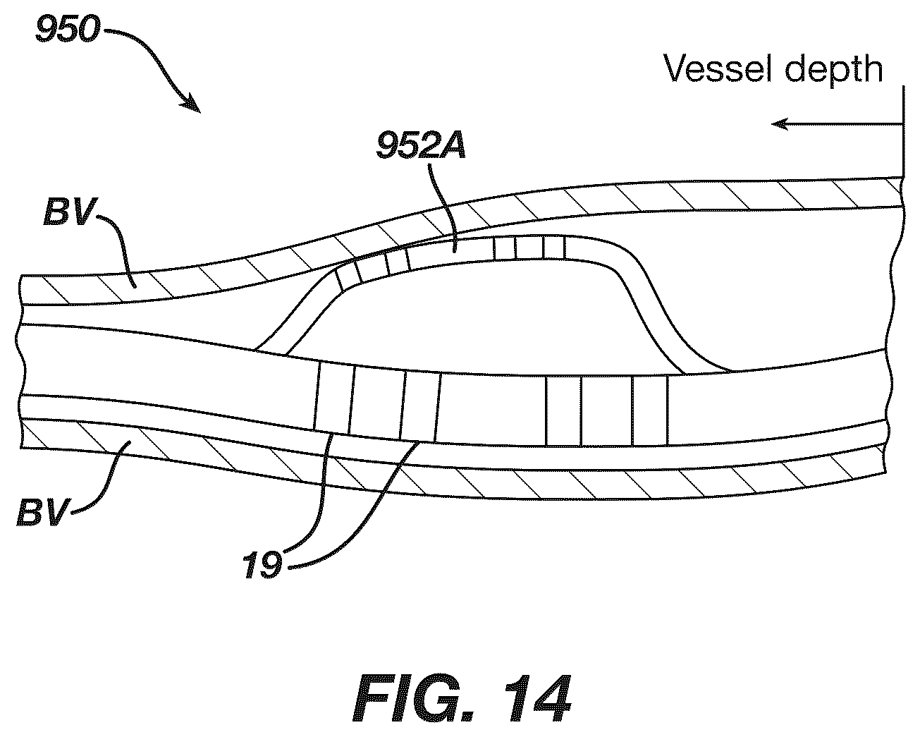 Patent US12097339 Figure 14 – System and methods of using a catheter with an anchoring mechanism