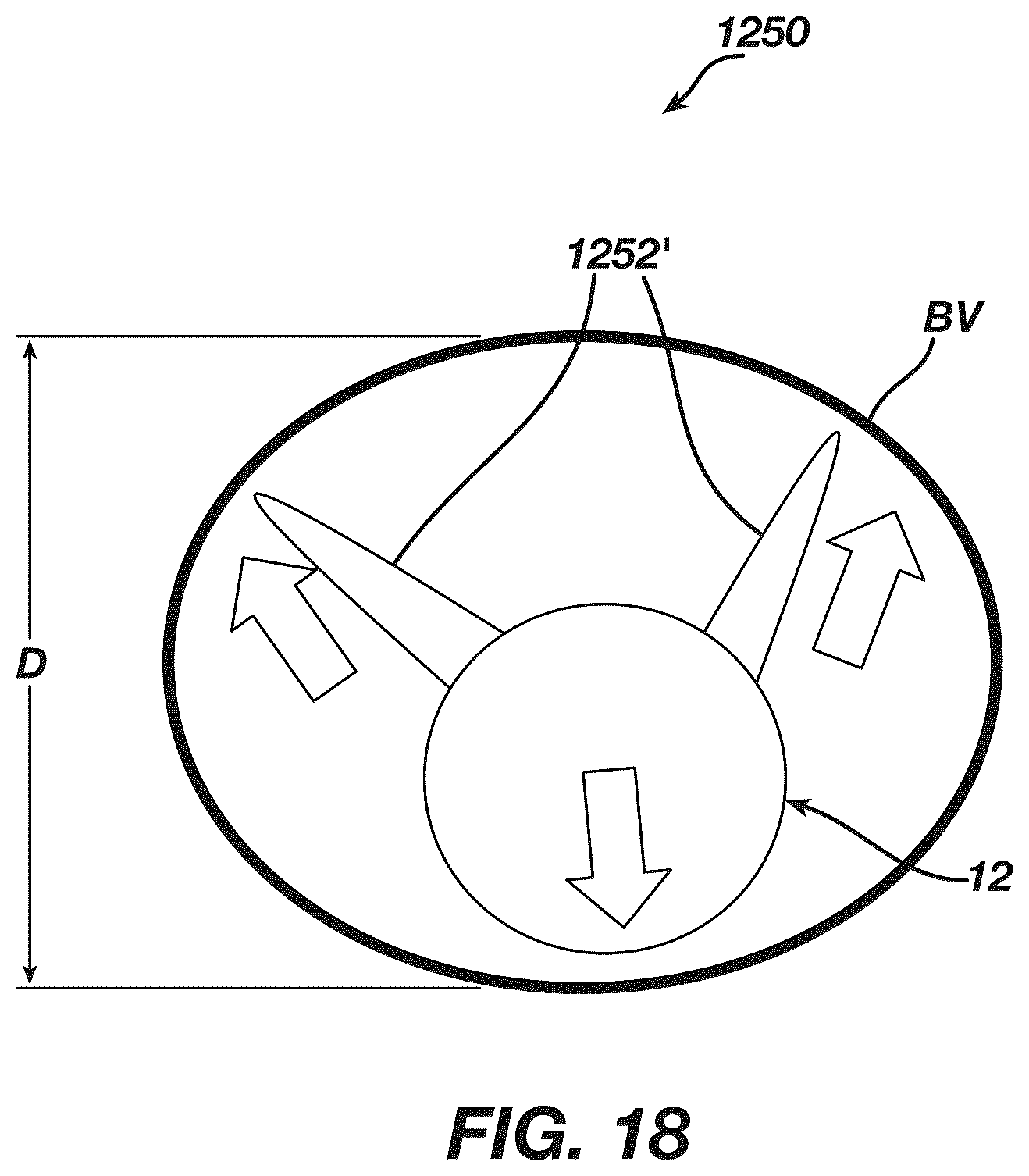 Patent US12097339 Figure 18 – System and methods of using a catheter with an anchoring mechanism