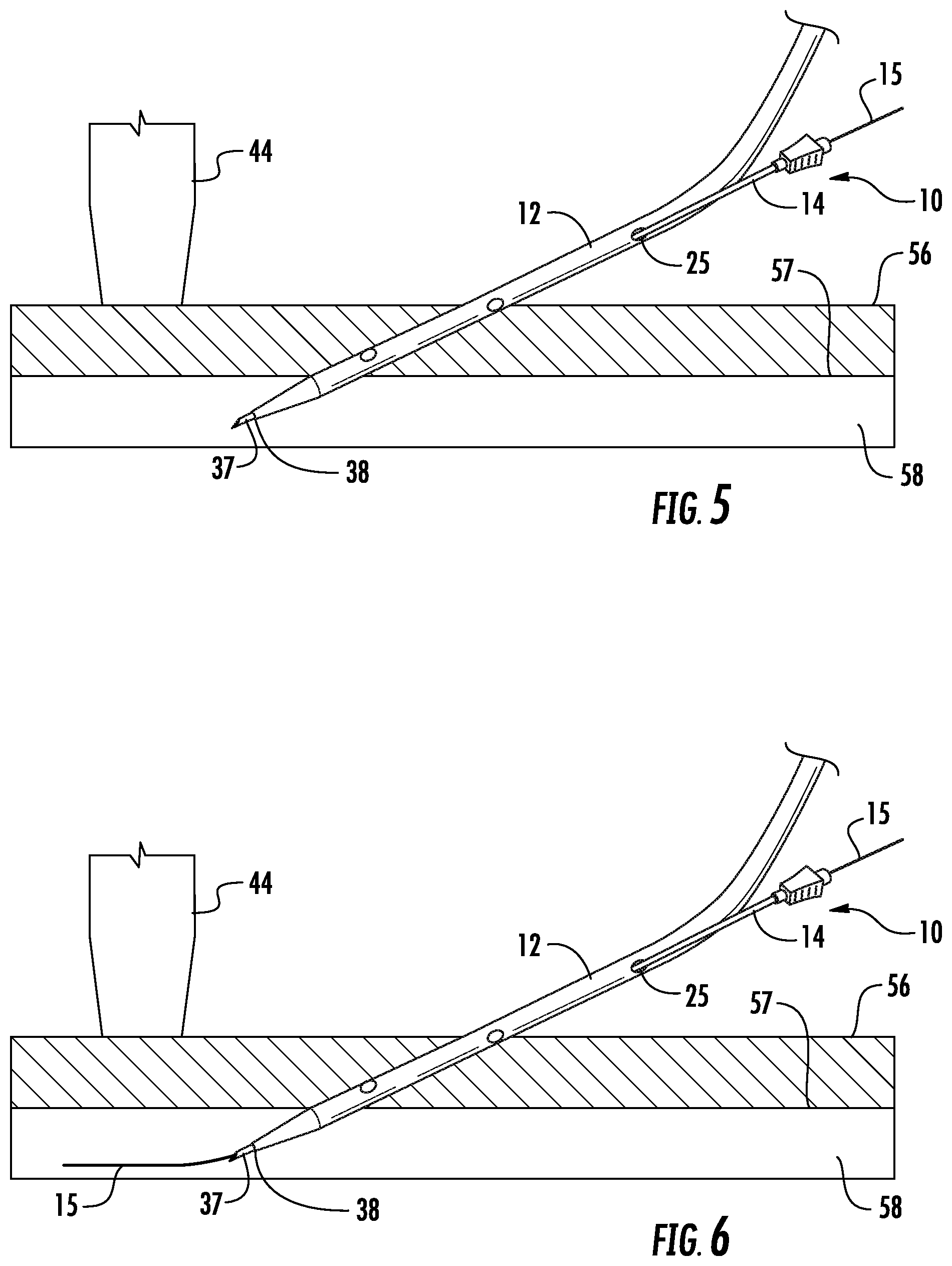 Patent US12097342 Figure 4 – Rapid insertion integrated catheter and method of using an integrated catheter