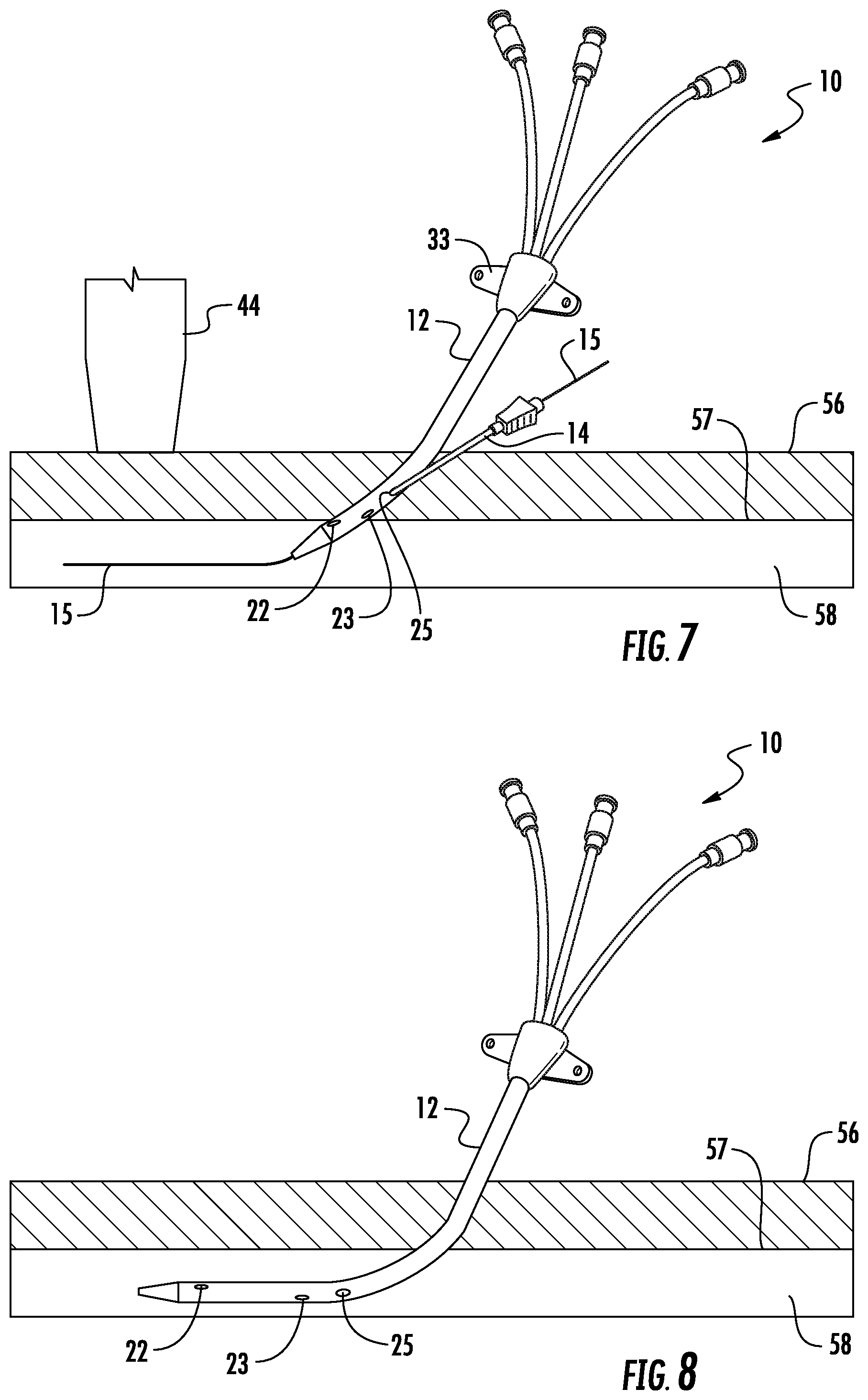 Patent US12097342 Figure 5 – Rapid insertion integrated catheter and method of using an integrated catheter
