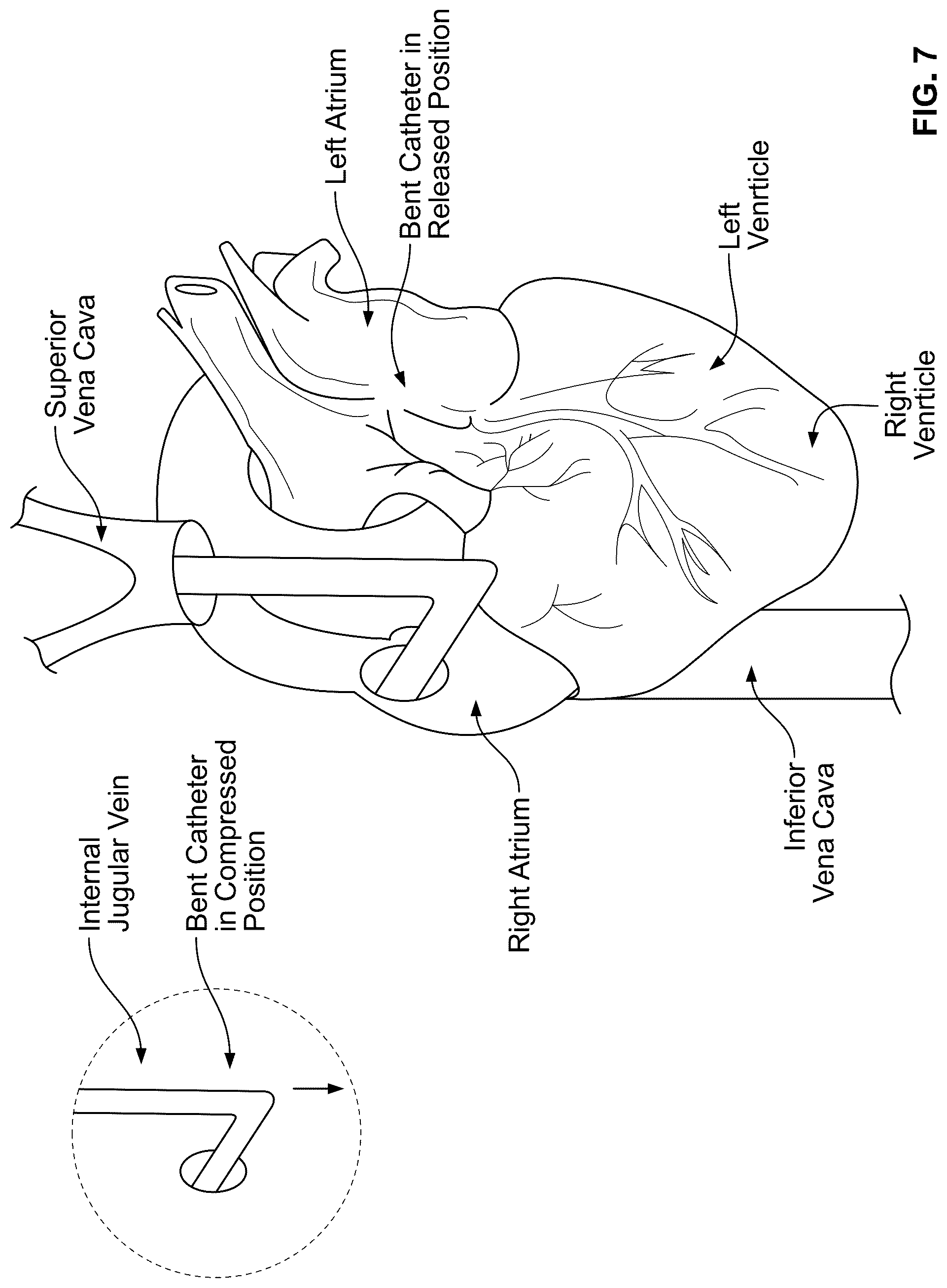 Patent US12097345 Figure 9 – Infusion catheter and methods of use