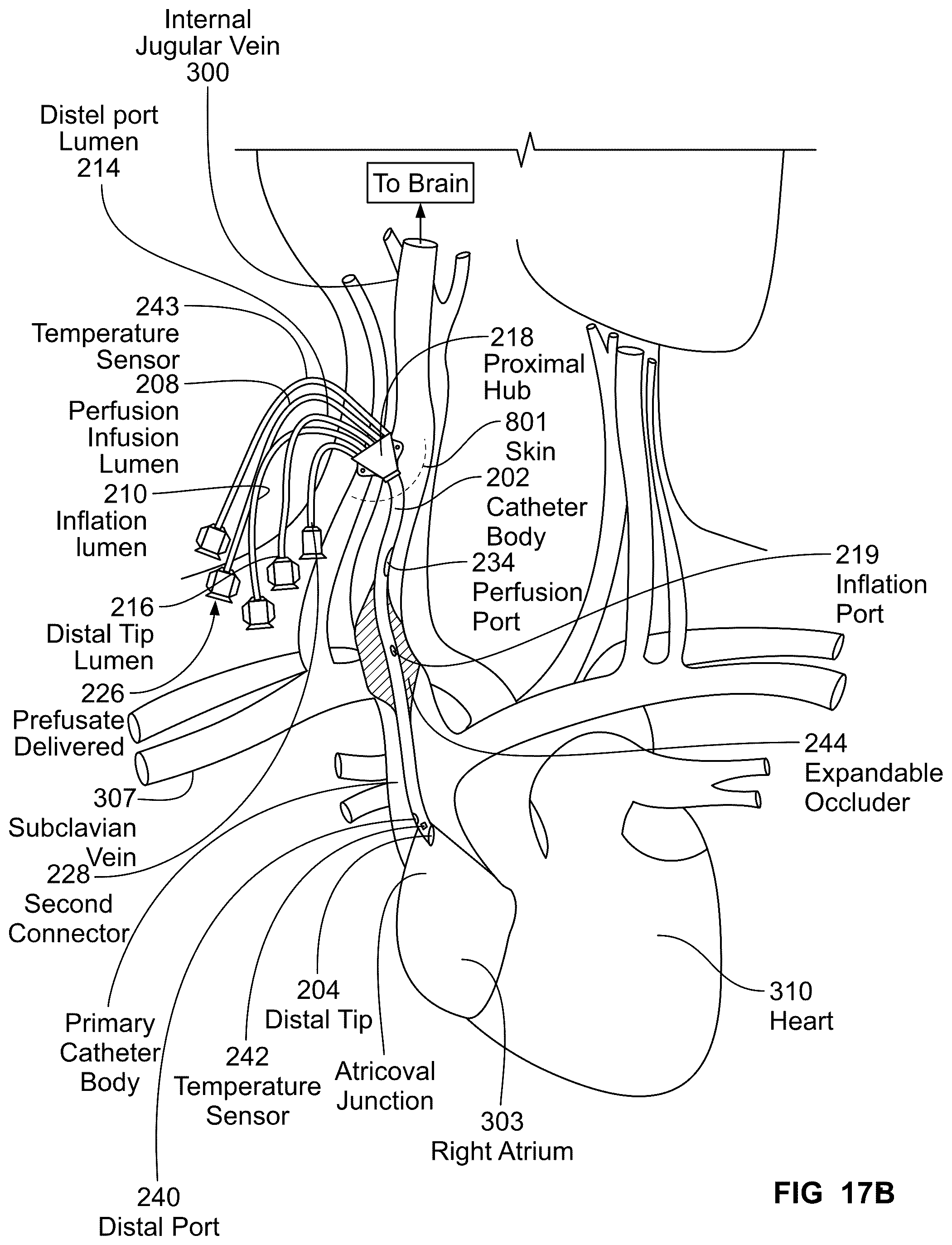 Patent US12097345 Figure 20 – Infusion catheter and methods of use