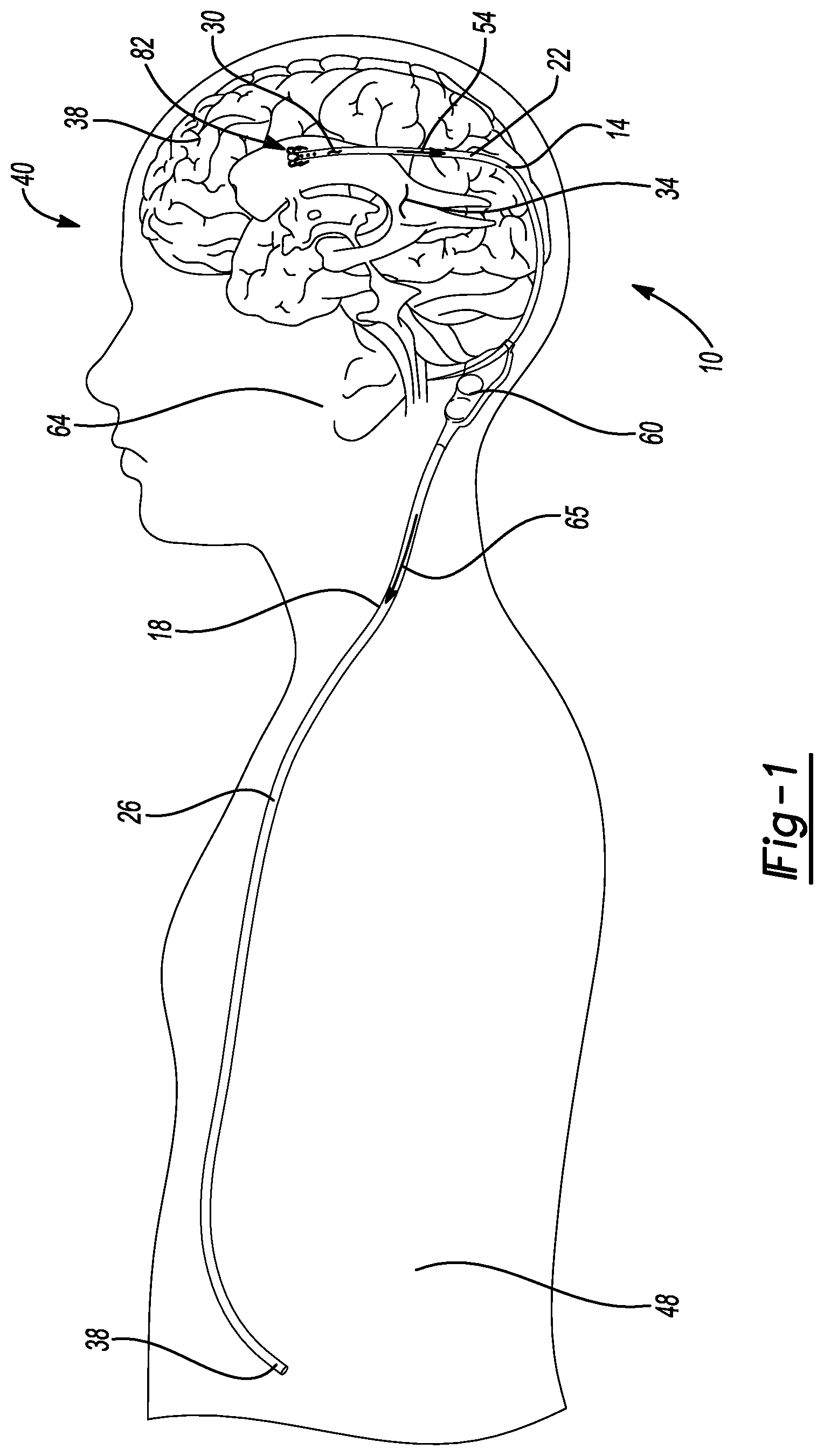 Patent US12097347 Figure 1 – System and method for a shunt
