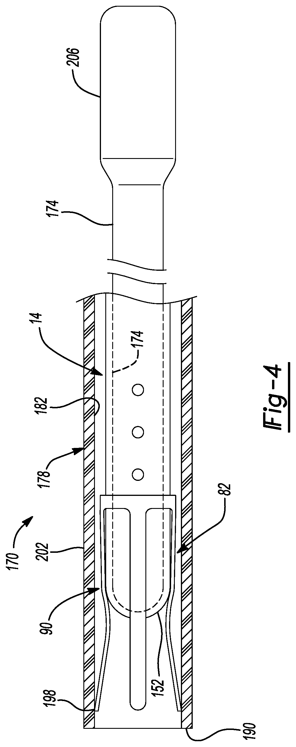 Patent US12097347 Figure 4 – System and method for a shunt