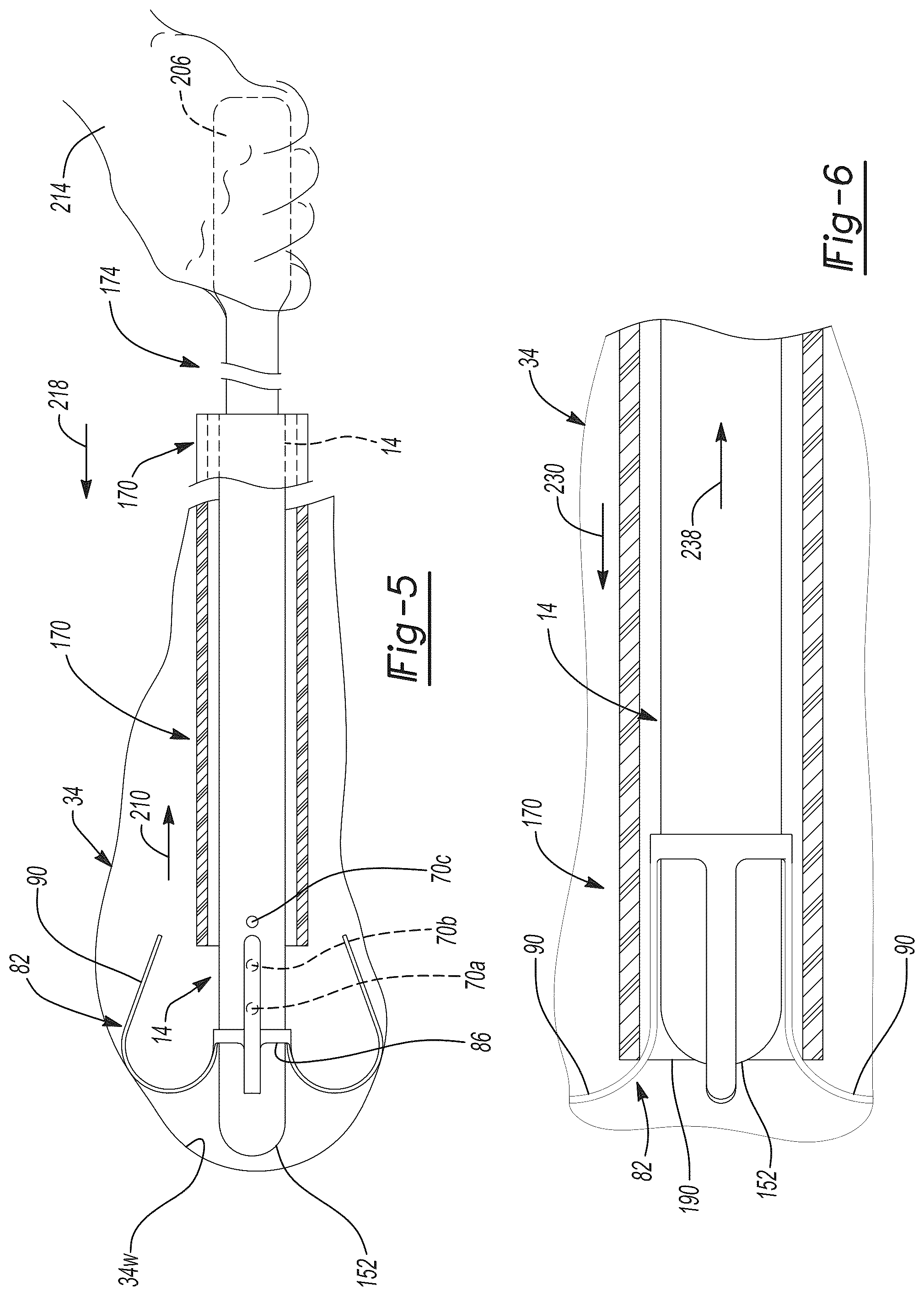 Patent US12097347 Figure 5 – System and method for a shunt