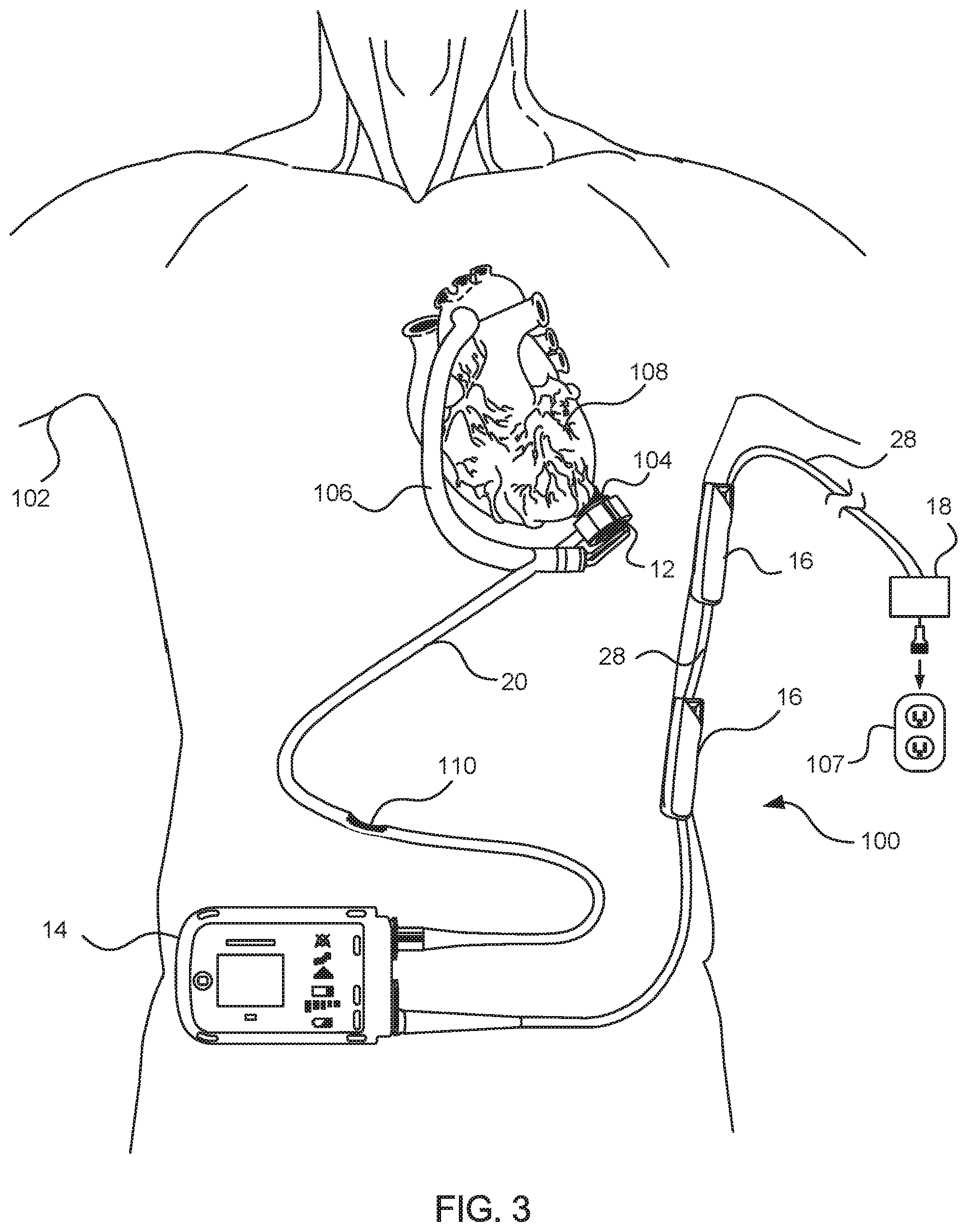 Patent US12097363 Figure 2 – Connectors and cables for use with ventricle assist systems