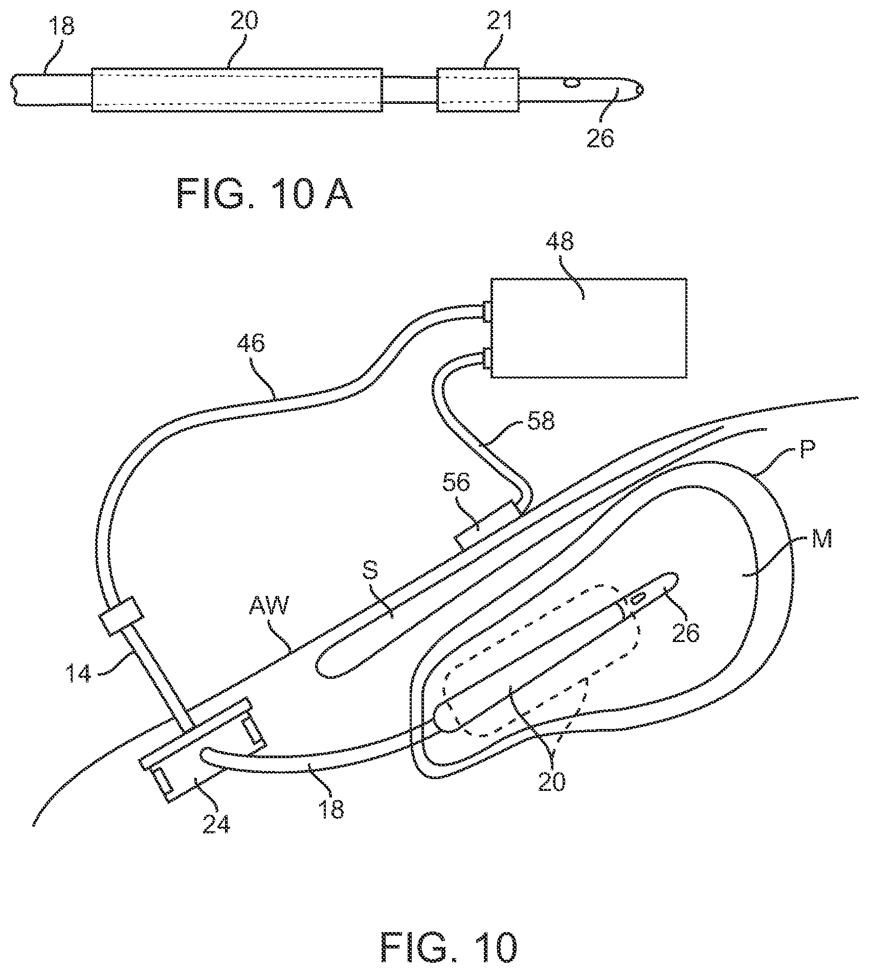 Patent US12097364 Figure 8 – Apparatus, systems, and methods for percutaneous pneumatic cardiac assistance
