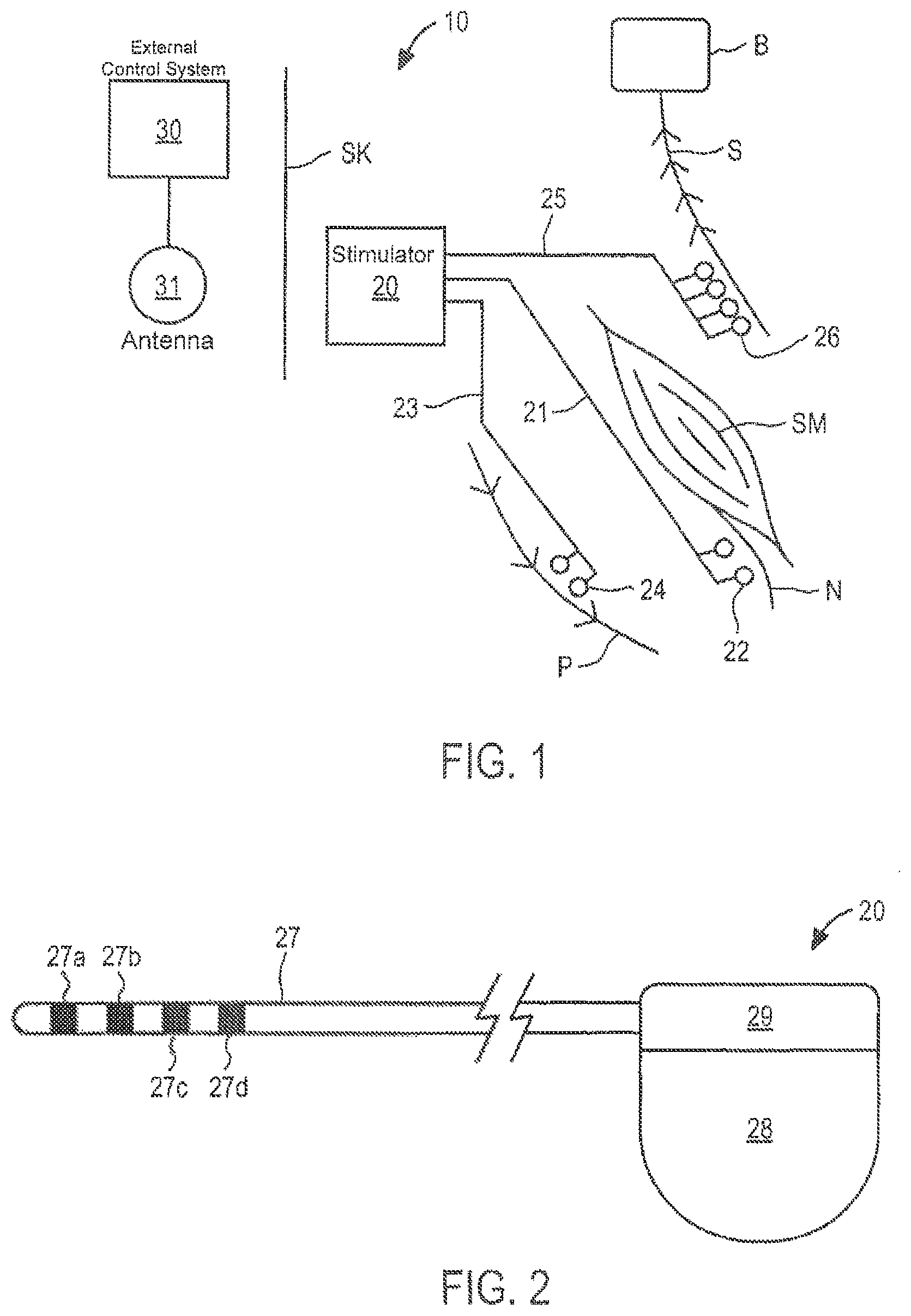 Patent US12097365 Figure 1 – Electrical stimulator for the treatment of back pain and methods of use