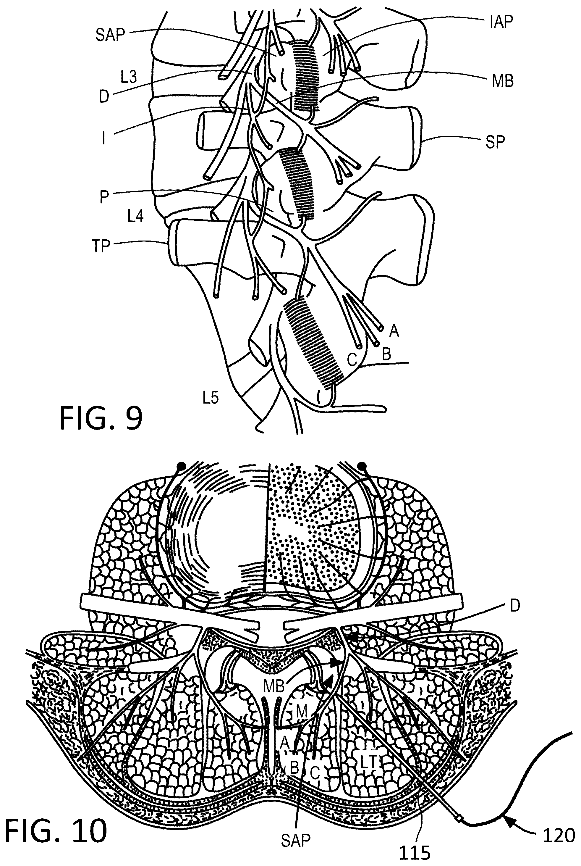 Patent US12097365 Figure 5 – Electrical stimulator for the treatment of back pain and methods of use