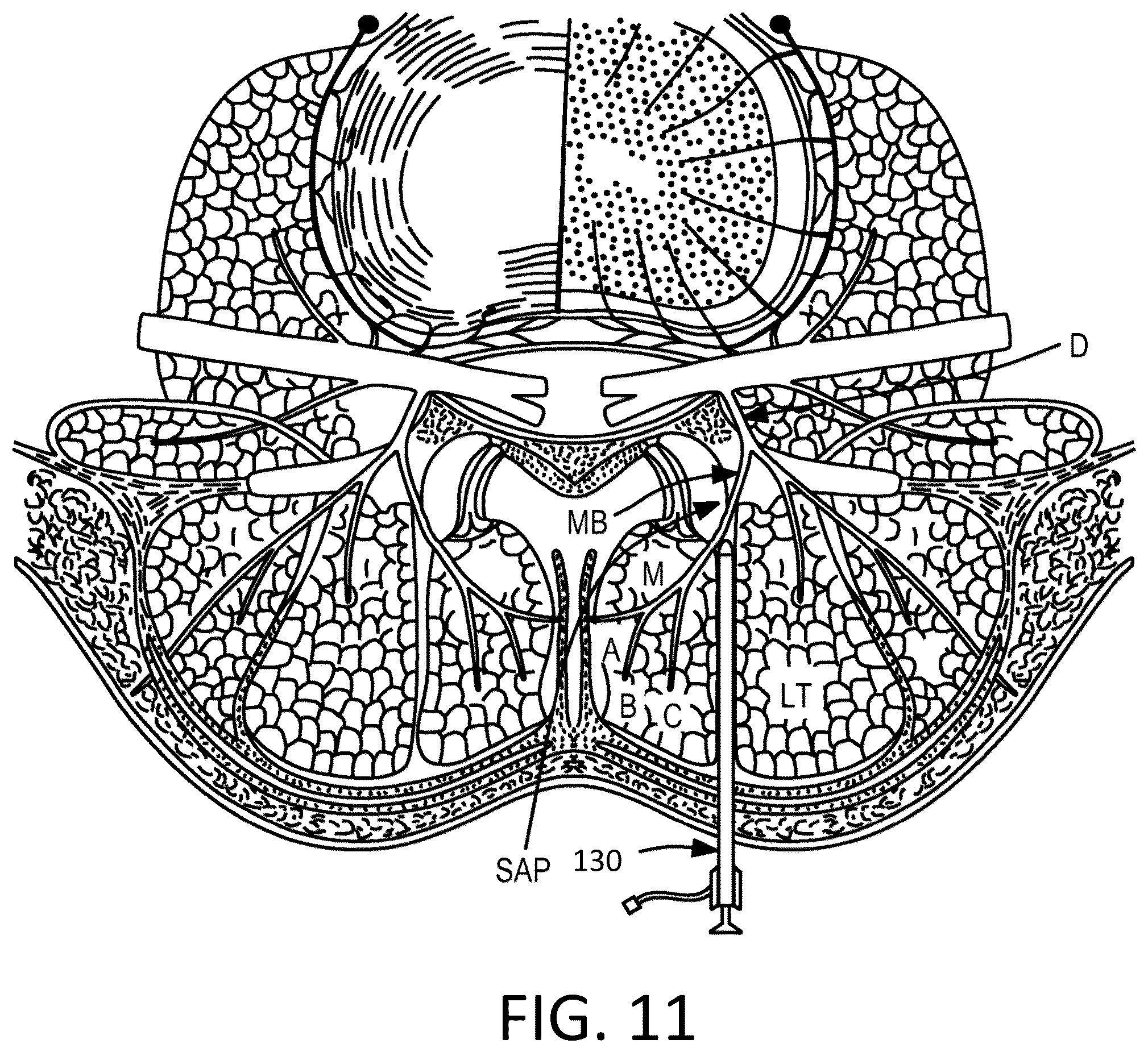 Patent US12097365 Figure 6 – Electrical stimulator for the treatment of back pain and methods of use