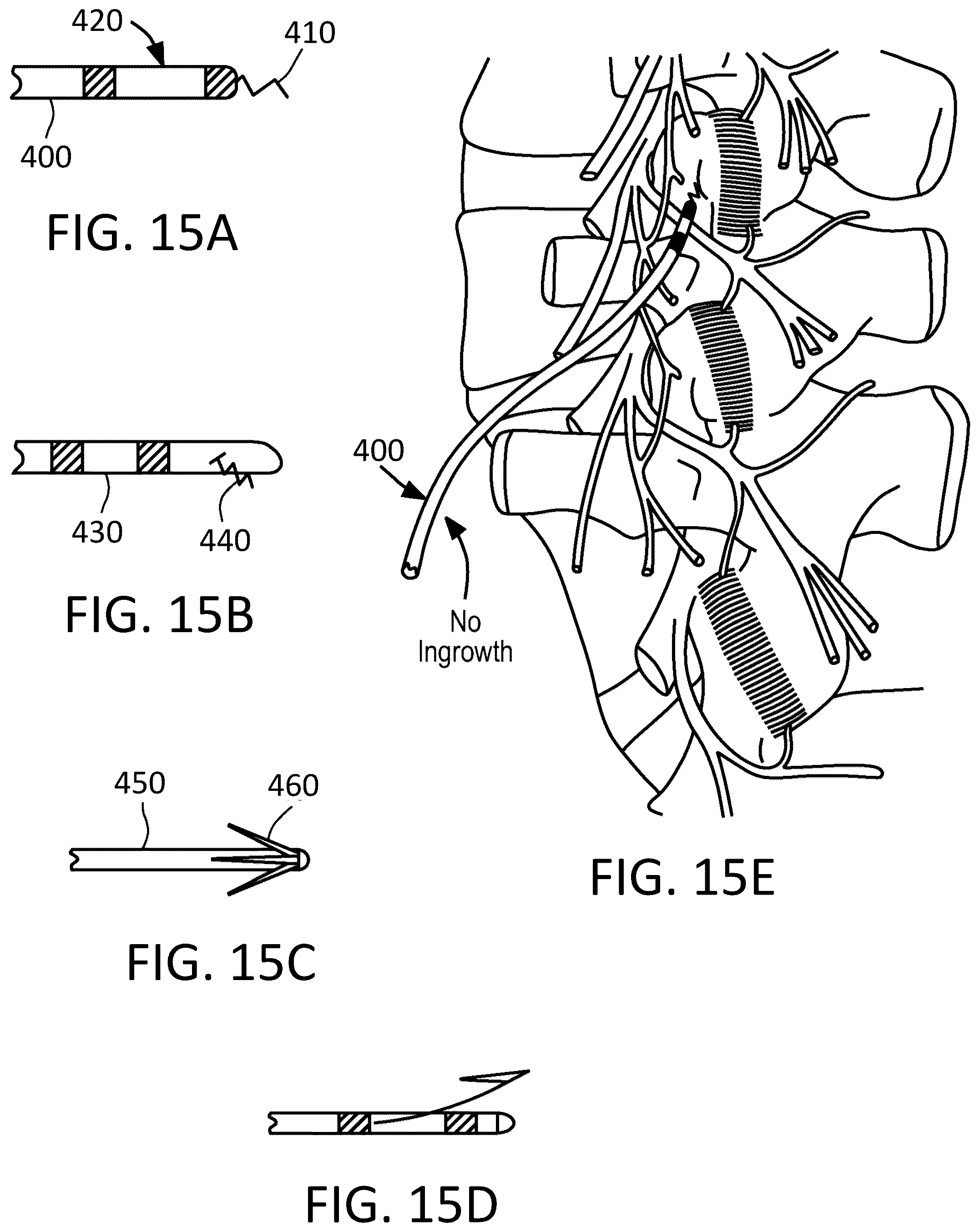 Patent US12097365 Figure 9 – Electrical stimulator for the treatment of back pain and methods of use