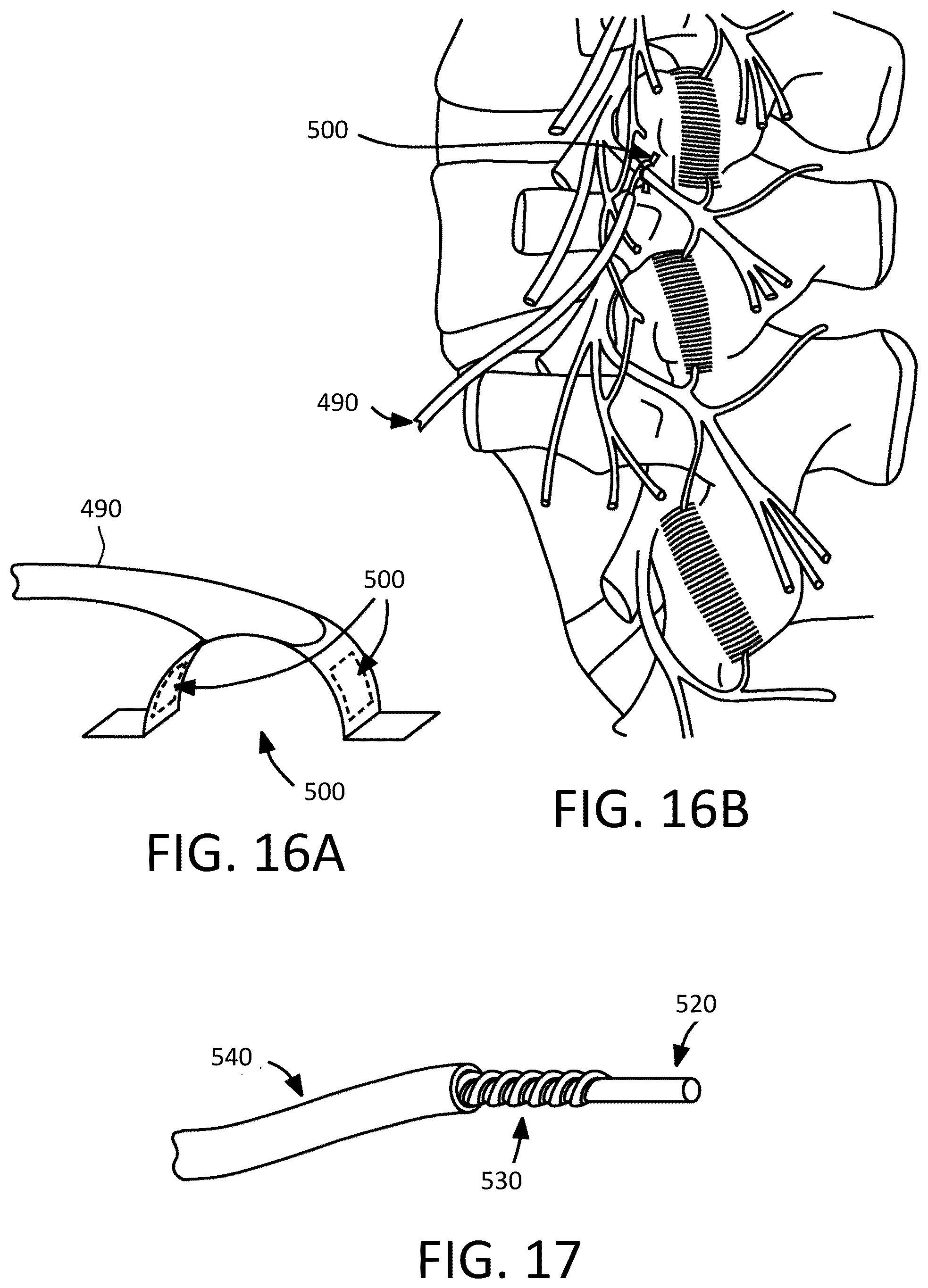 Patent US12097365 Figure 10 – Electrical stimulator for the treatment of back pain and methods of use