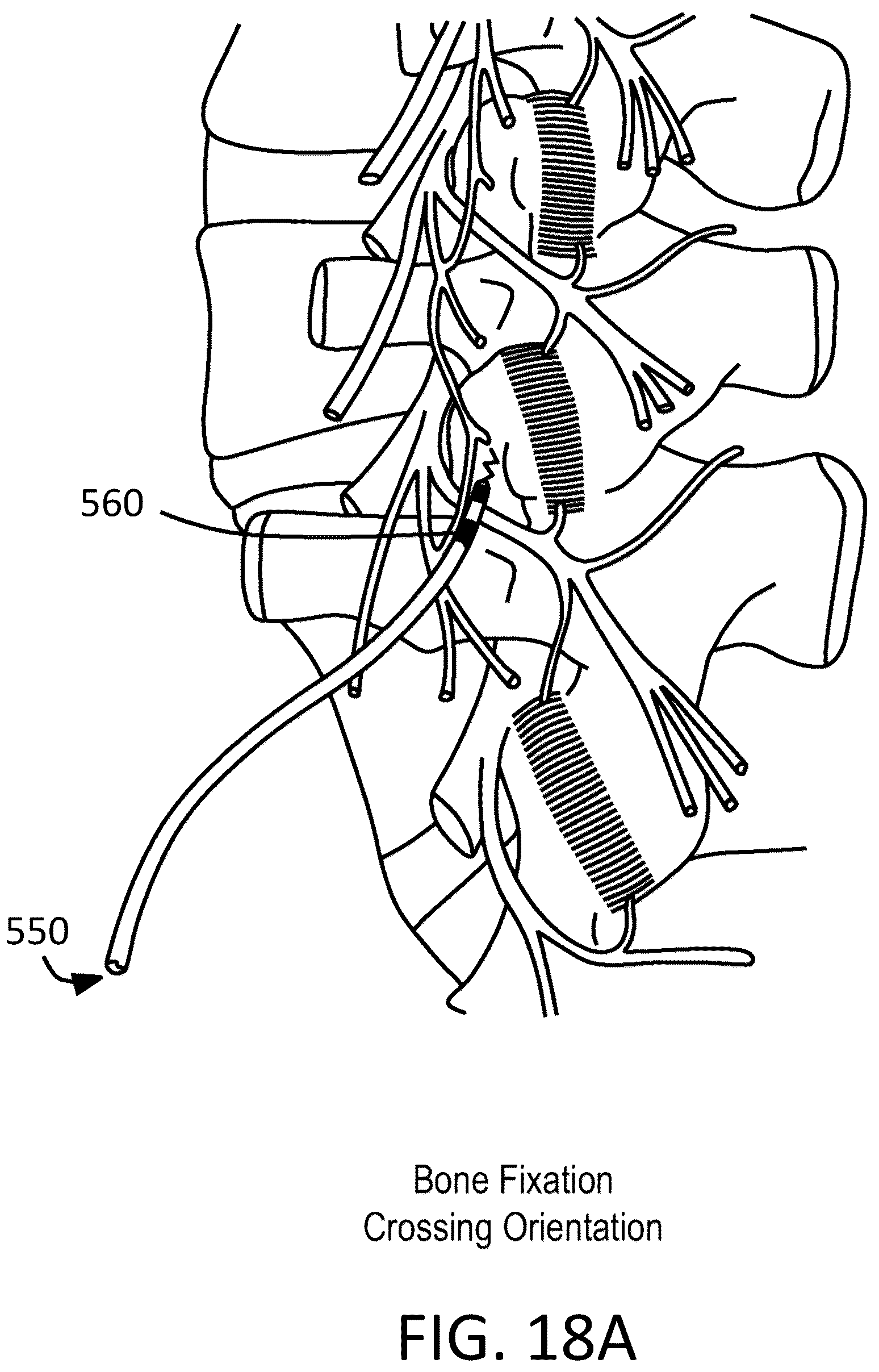 Patent US12097365 Figure 11 – Electrical stimulator for the treatment of back pain and methods of use