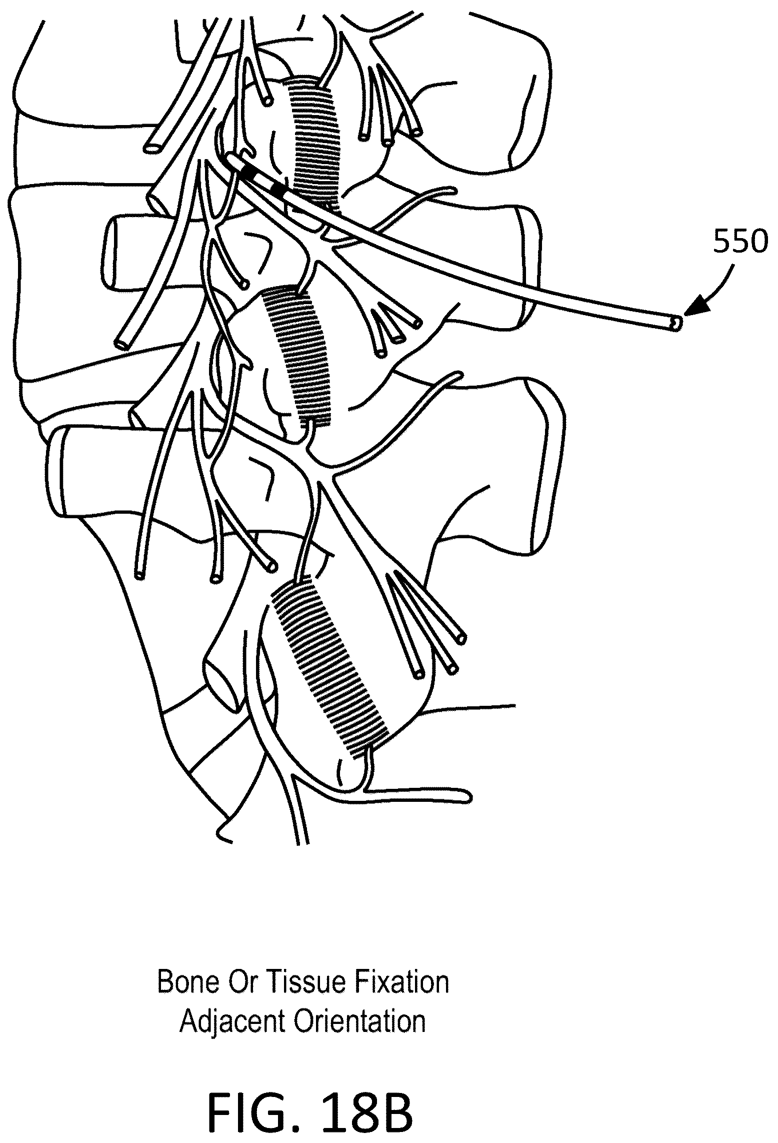 Patent US12097365 Figure 12 – Electrical stimulator for the treatment of back pain and methods of use