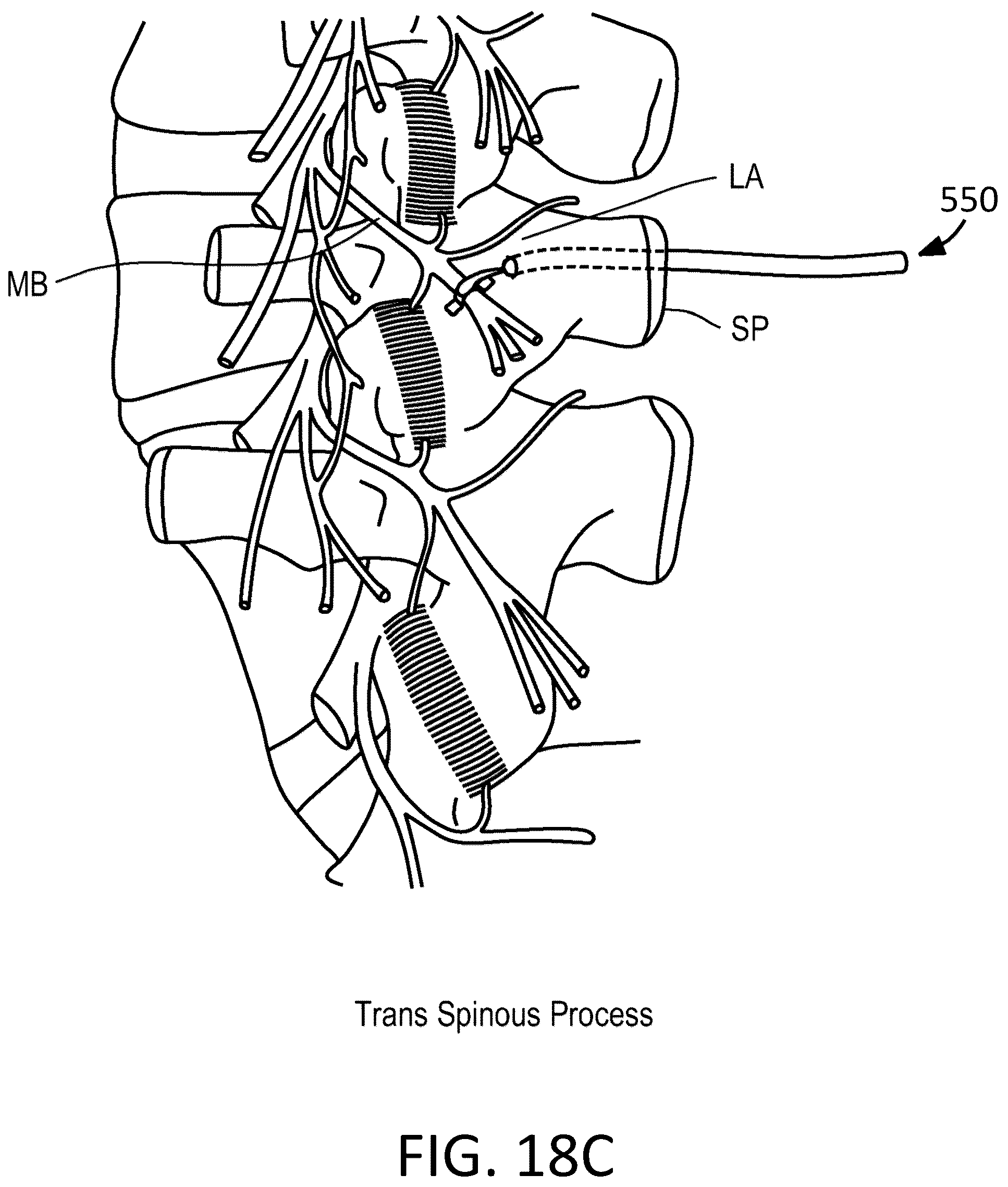 Patent US12097365 Figure 13 – Electrical stimulator for the treatment of back pain and methods of use