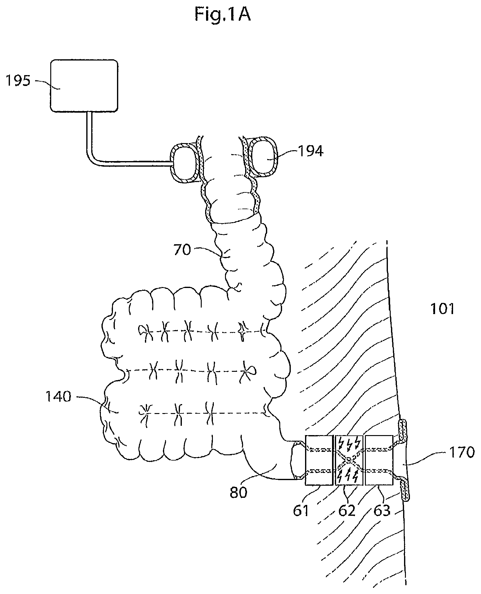 Patent US12097368 Figure 1 – System for treating a patient having an intestinal disorder