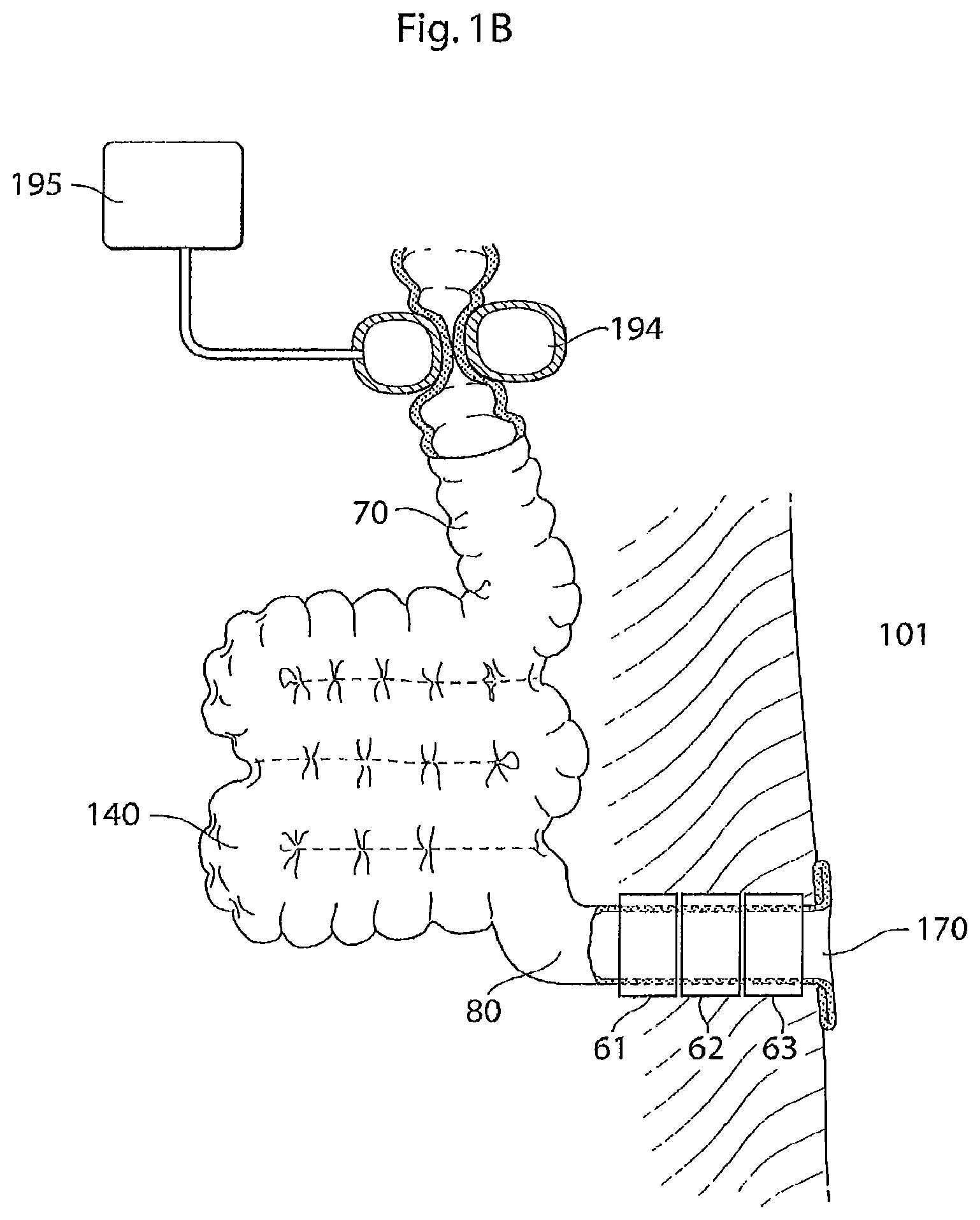 Patent US12097368 Figure 2 – System for treating a patient having an intestinal disorder
