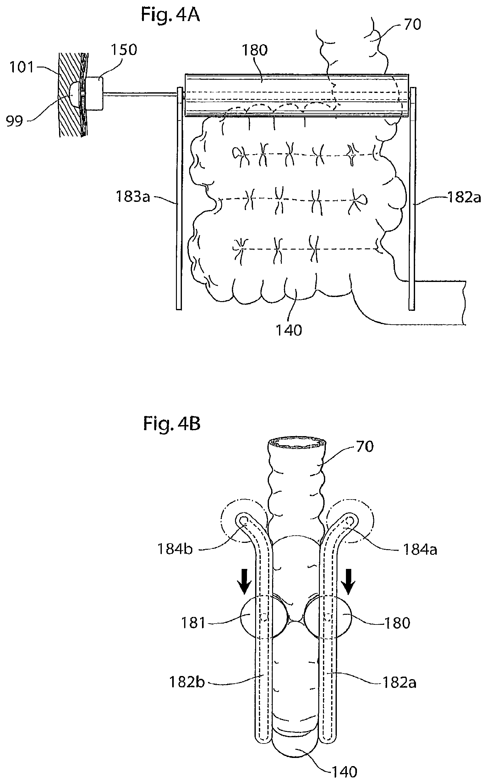 Patent US12097368 Figure 5 – System for treating a patient having an intestinal disorder