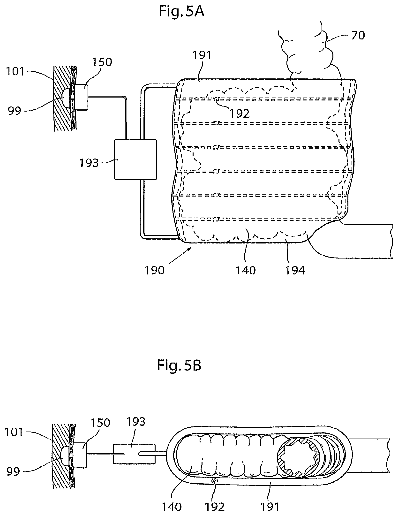 Patent US12097368 Figure 6 – System for treating a patient having an intestinal disorder