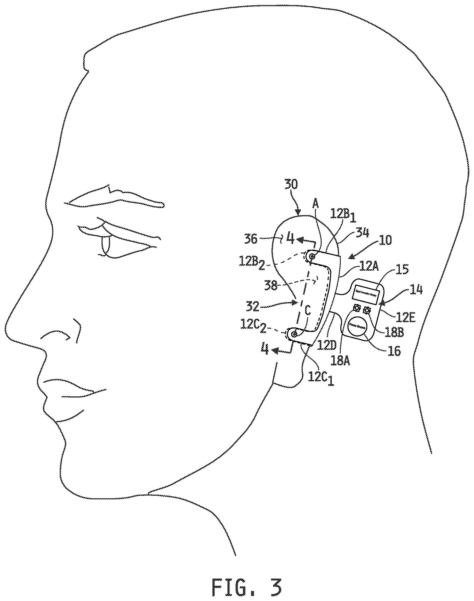 Patent US12097371 Figure 2 – Auricular nerve field stimulation device