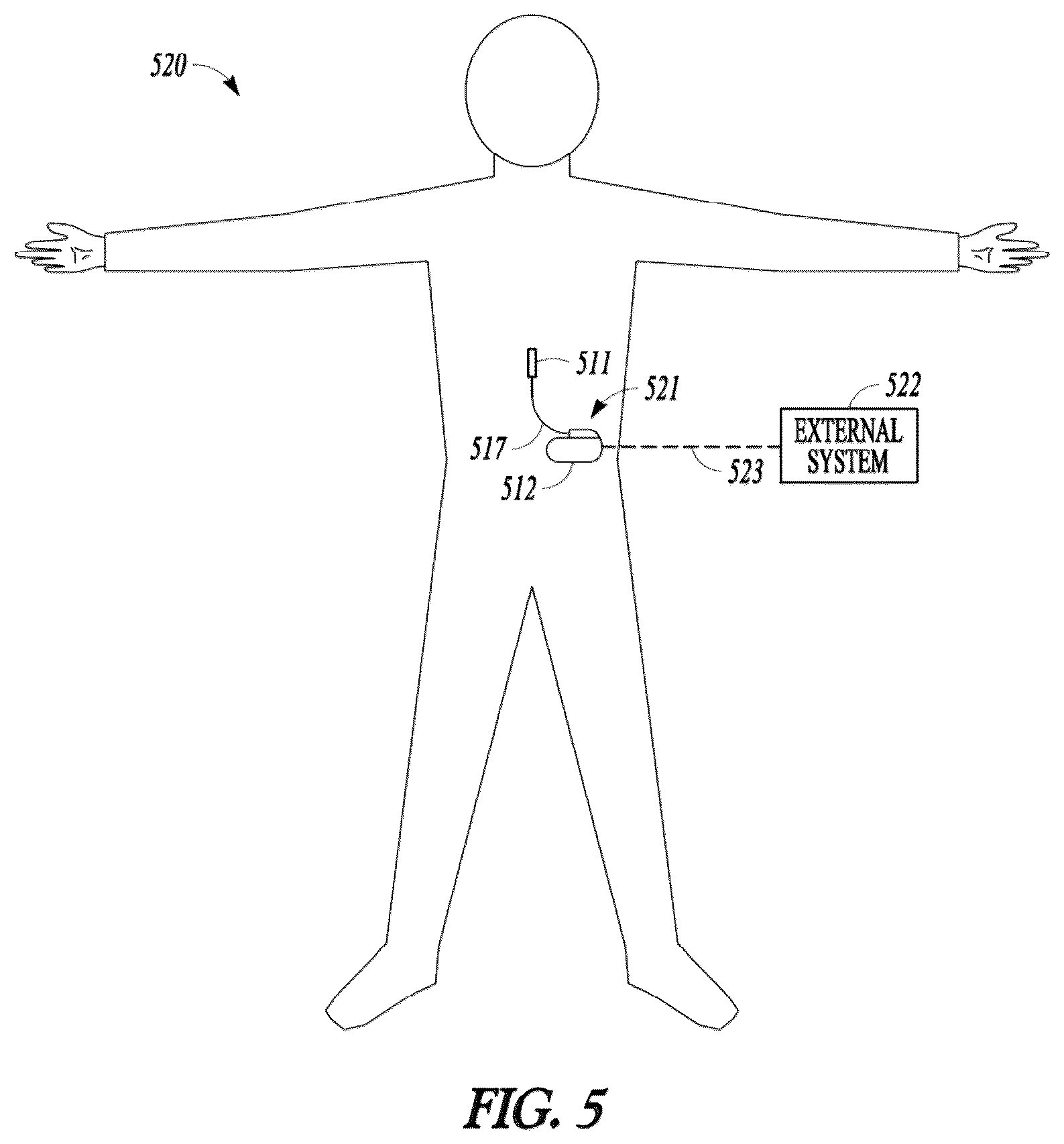 Patent US12097372 Figure 3 – Targeted electrostimulation fields based on focal dermatomal coverage