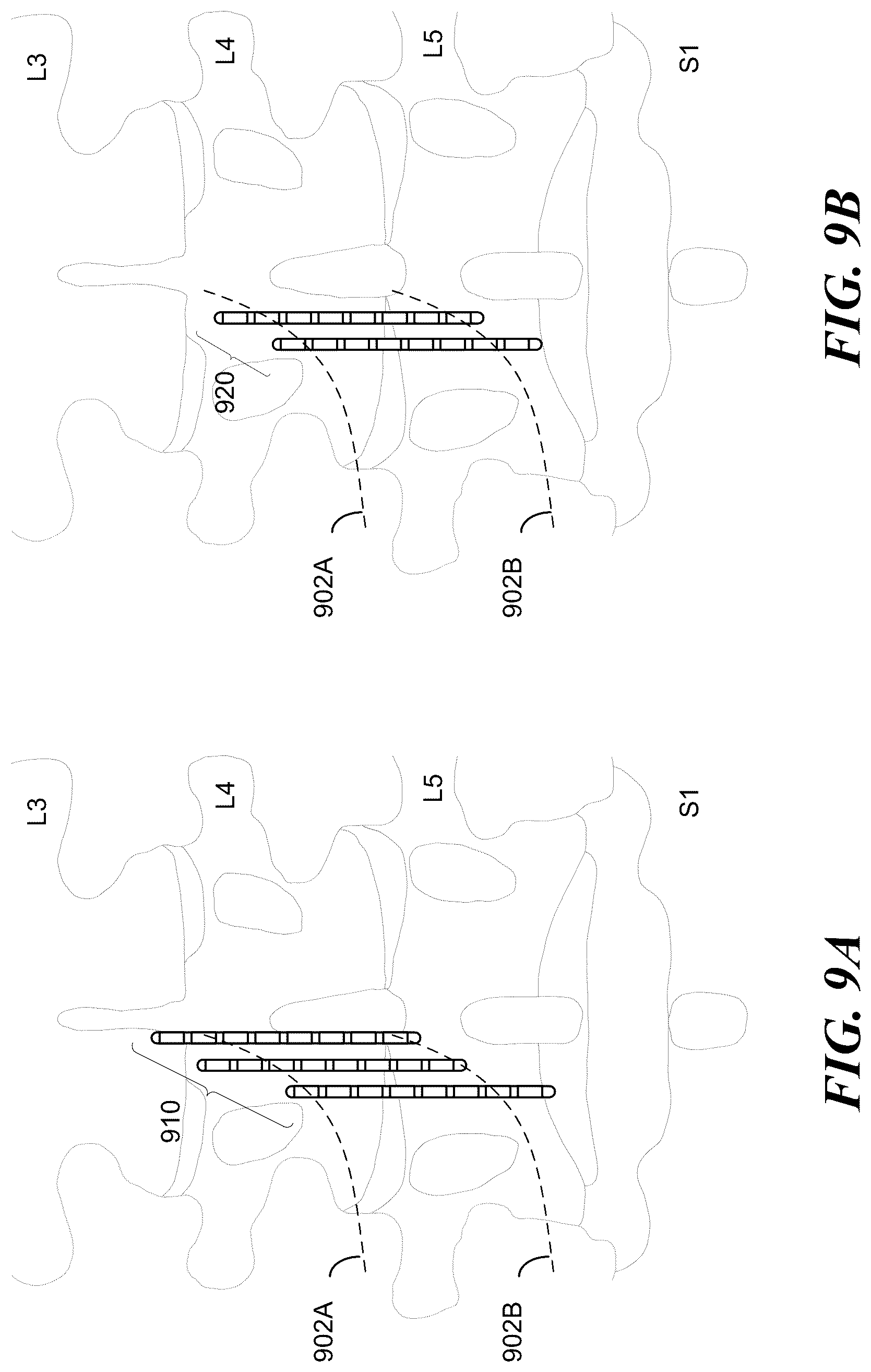 Patent US12097372 Figure 6 – Targeted electrostimulation fields based on focal dermatomal coverage