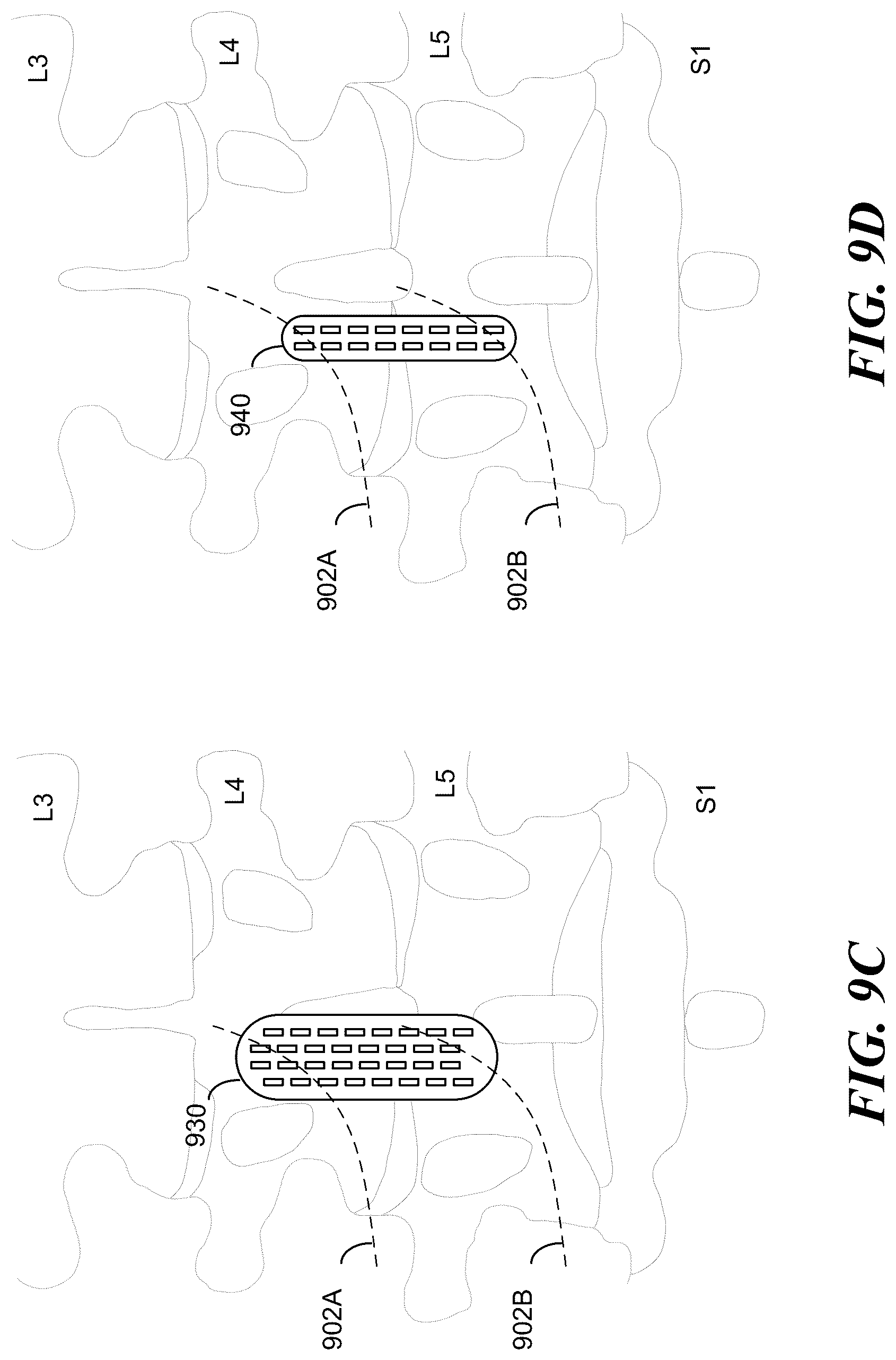 Patent US12097372 Figure 7 – Targeted electrostimulation fields based on focal dermatomal coverage