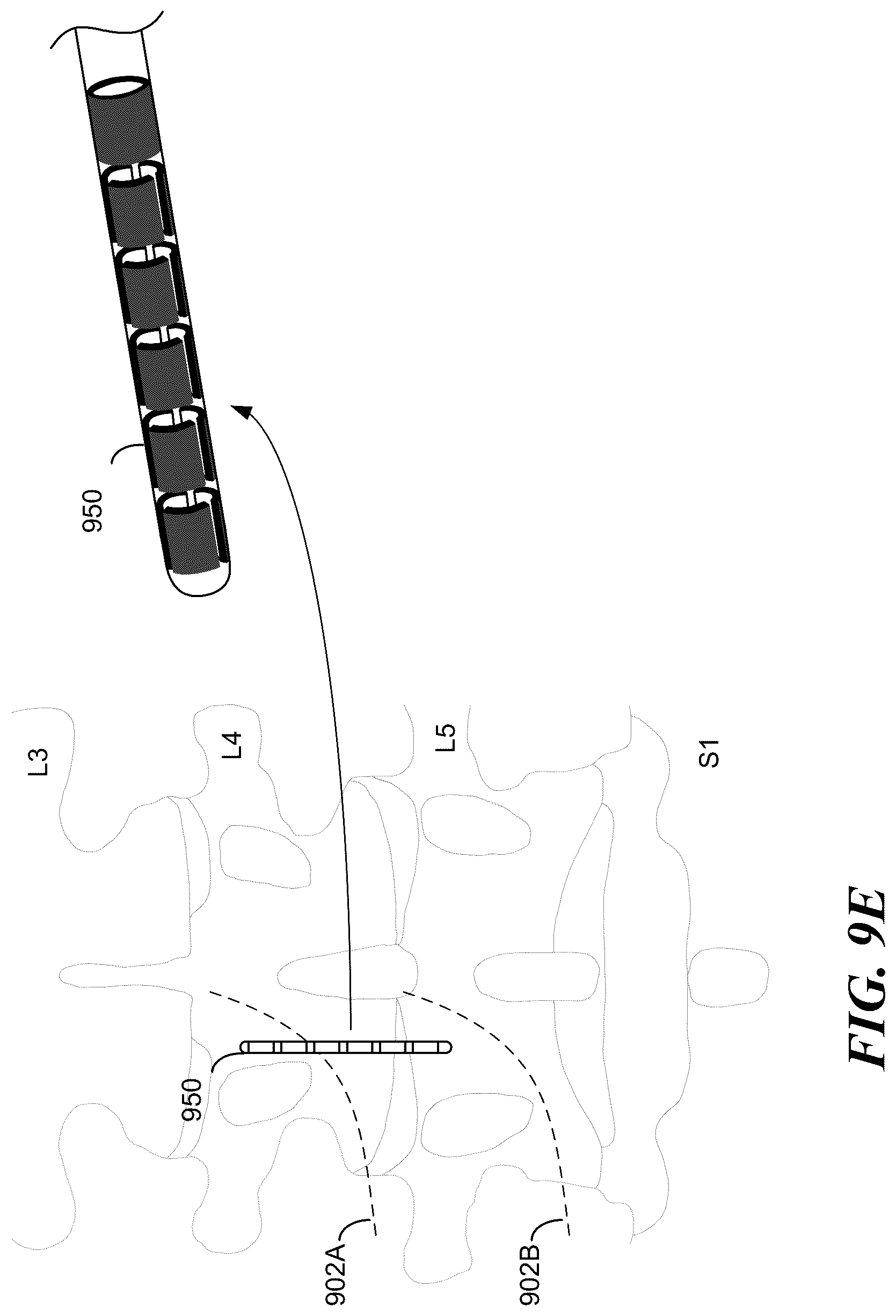 Patent US12097372 Figure 8 – Targeted electrostimulation fields based on focal dermatomal coverage
