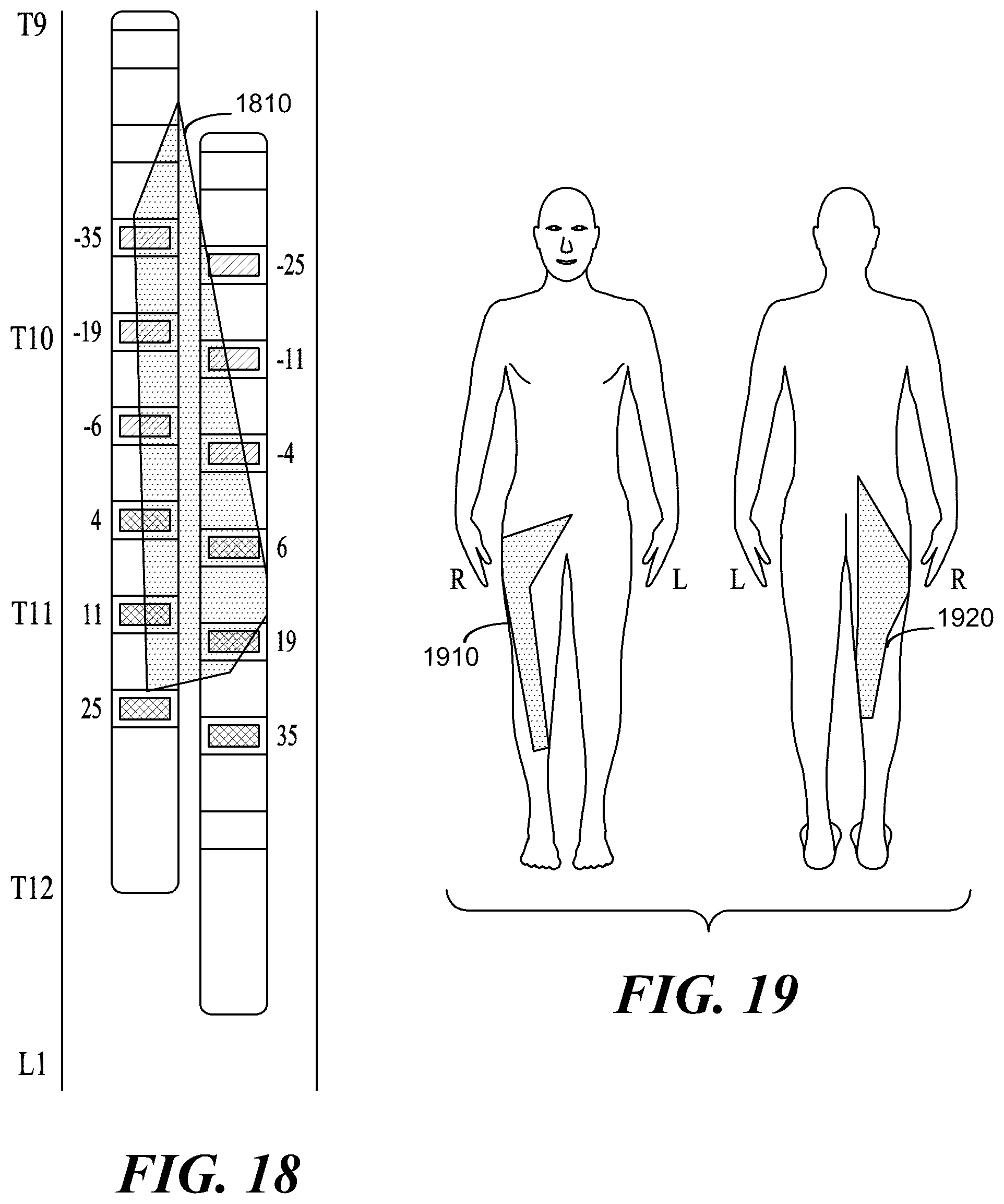 Patent US12097372 Figure 15 – Targeted electrostimulation fields based on focal dermatomal coverage