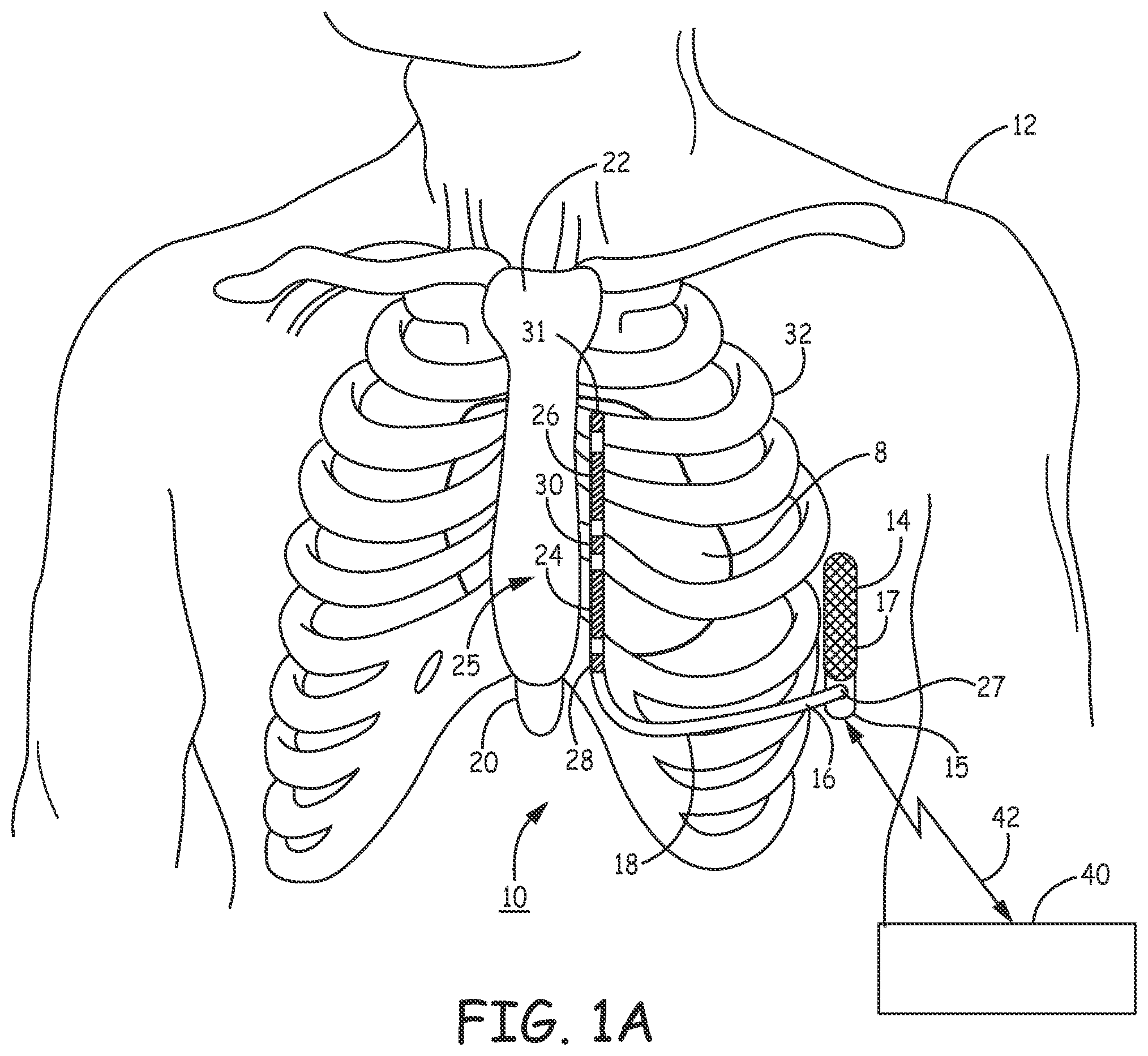 Patent US12097377 Figure 1 – Asystole detection and response in an implantable cardioverter defibrillator