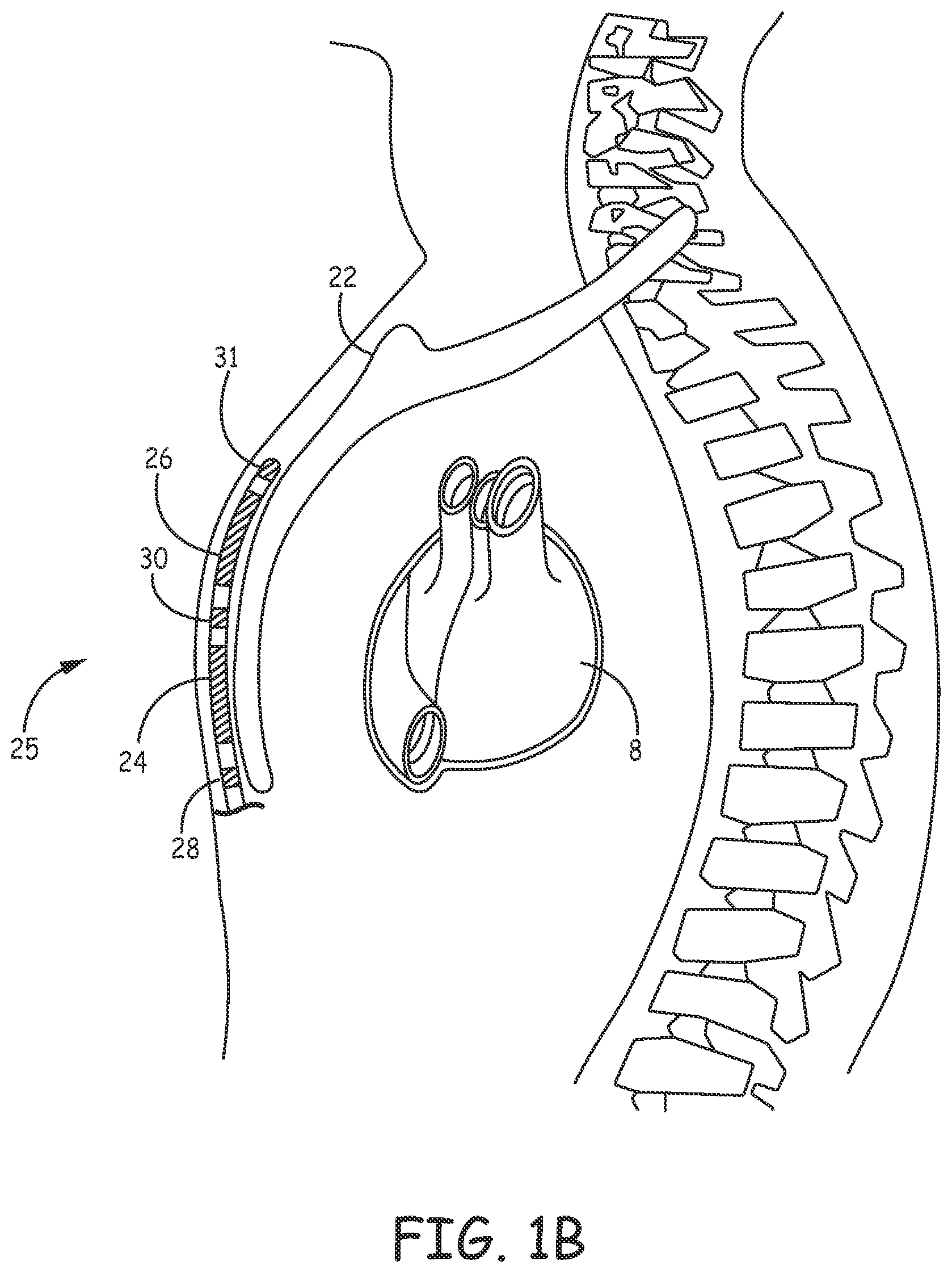 Patent US12097377 Figure 2 – Asystole detection and response in an implantable cardioverter defibrillator