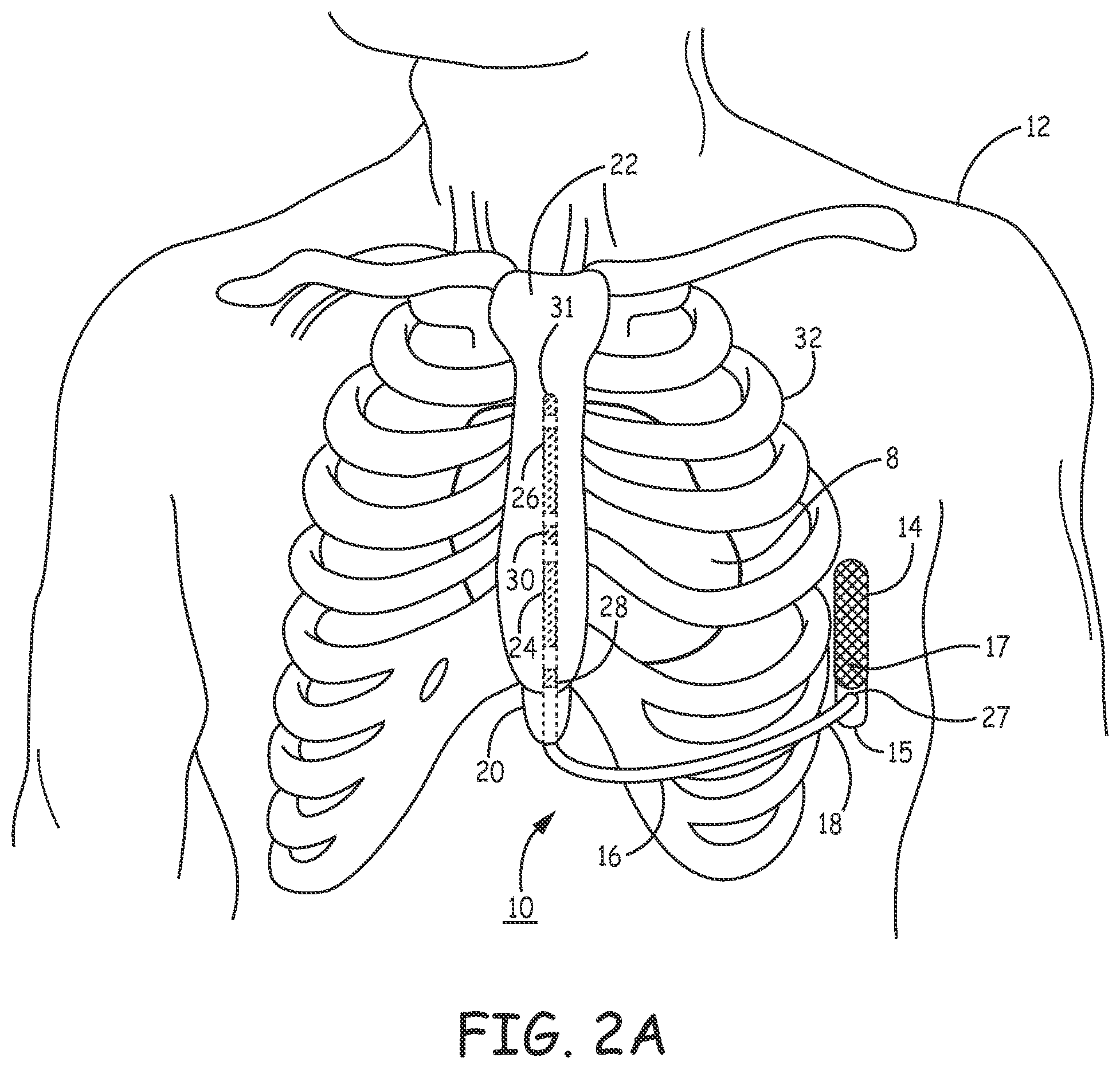 Patent US12097377 Figure 3 – Asystole detection and response in an implantable cardioverter defibrillator