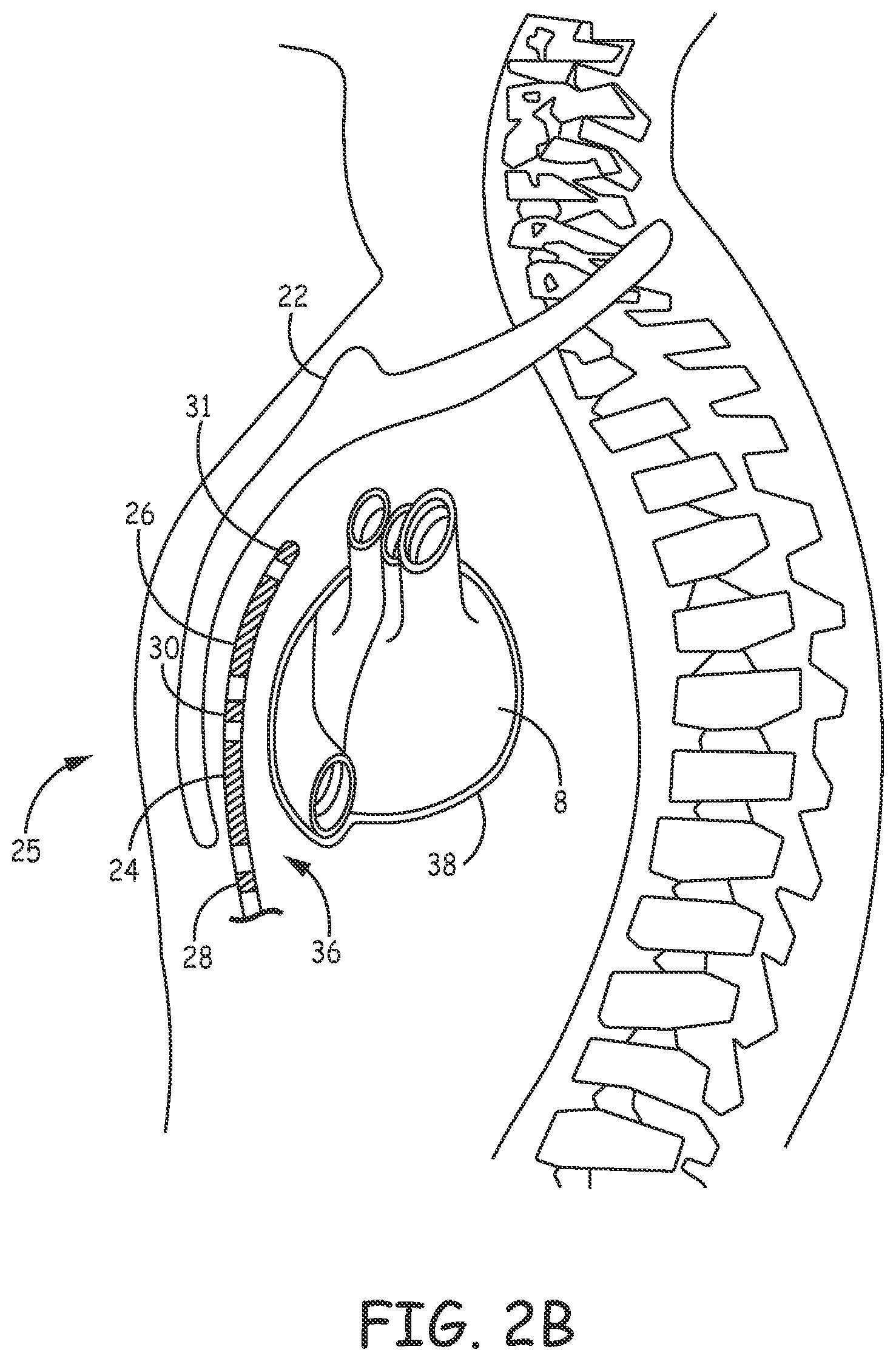 Patent US12097377 Figure 4 – Asystole detection and response in an implantable cardioverter defibrillator