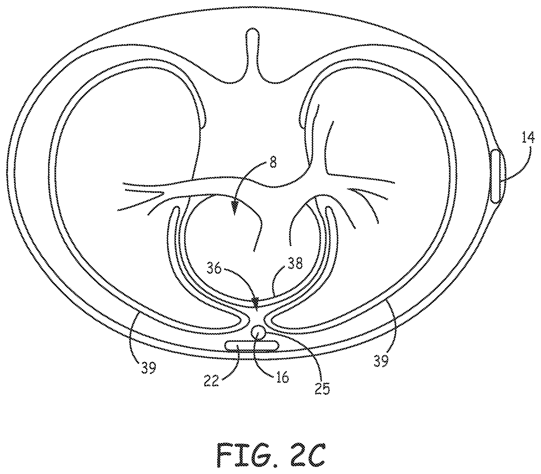 Patent US12097377 Figure 5 – Asystole detection and response in an implantable cardioverter defibrillator