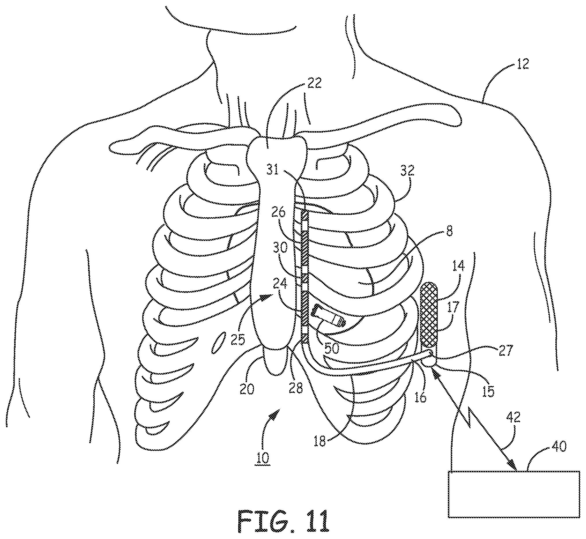 Patent US12097377 Figure 13 – Asystole detection and response in an implantable cardioverter defibrillator